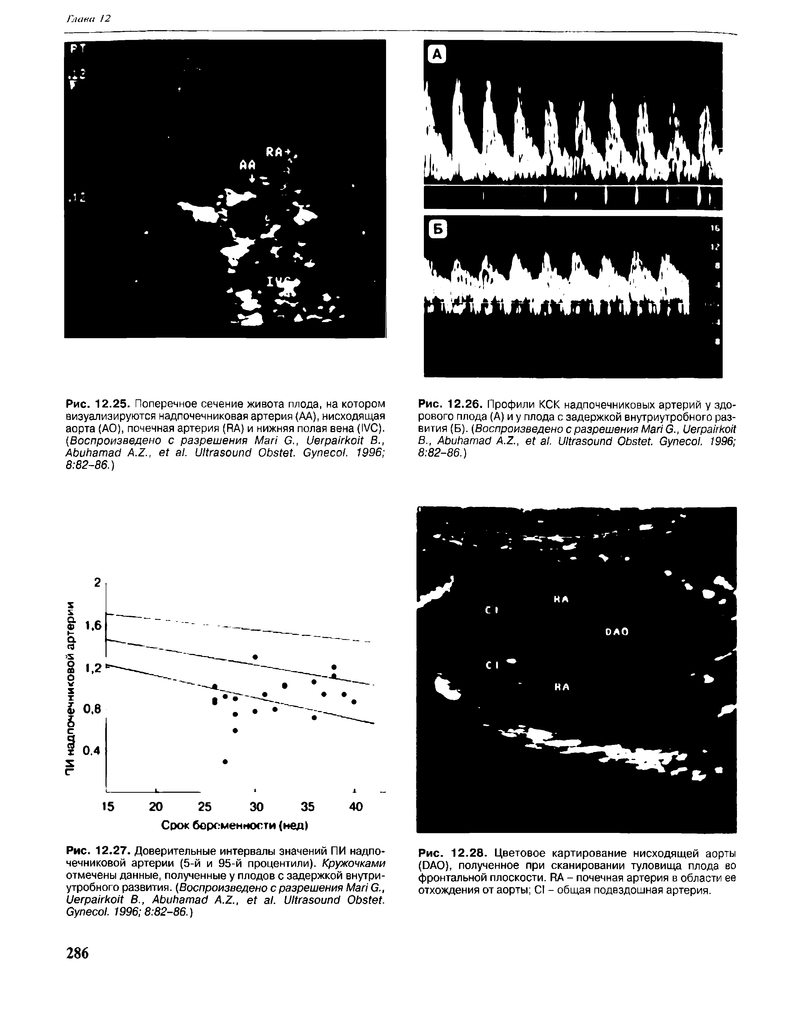 Рис. 12.28. Цветовое картирование нисходящей аорты (DAO), полученное при сканировании туловища плода во фронтальной плоскости. RA - почечная артерия в области ее отхождения от аорты CI - общая подвздошная артерия.