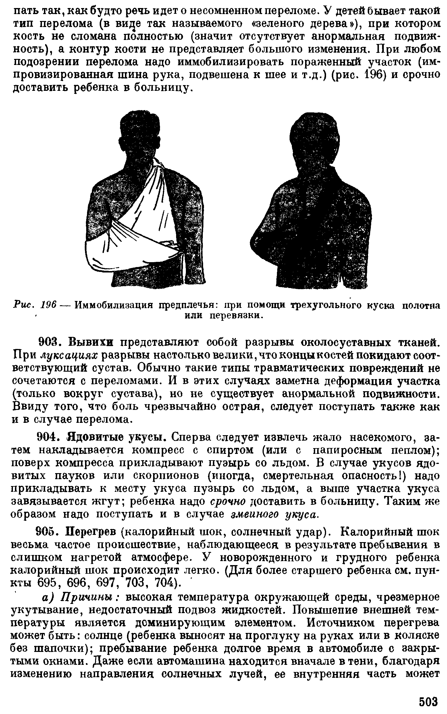 Рис. 796 — Иммобилизация предплечья при помощи трехугольного куска полотна или перевязки.