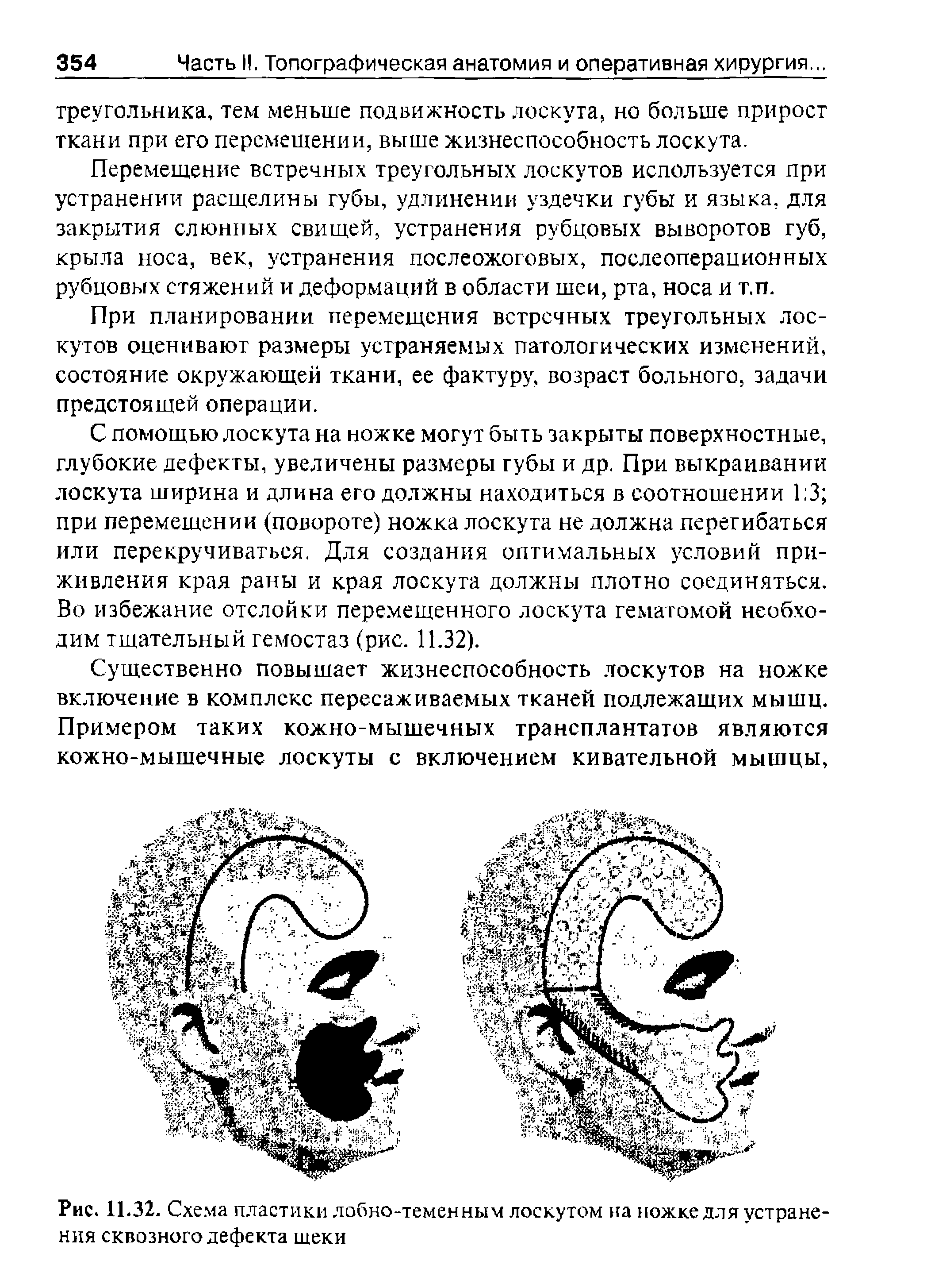 Рис. 11.32. Схема пластики лобно-теменным лоскутом на ножке для устранения сквозного дефекта шеки...