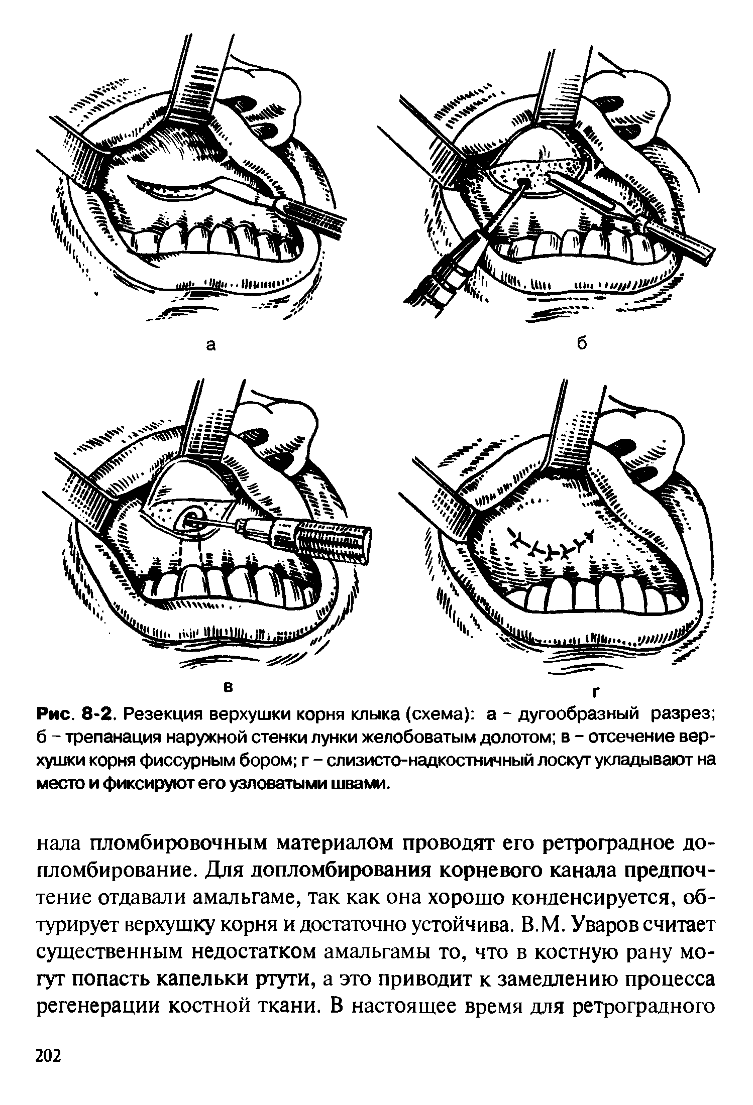 Рис. 8-2. Резекция верхушки корня клыка (схема) а - дугообразный разрез б - трепанация наружной стенки лунки желобоватым долотом в - отсечение верхушки корня фиссурным бором г - слизисто-надкостничный лоскут укладывают на место и фиксируют его узловатыми швами.