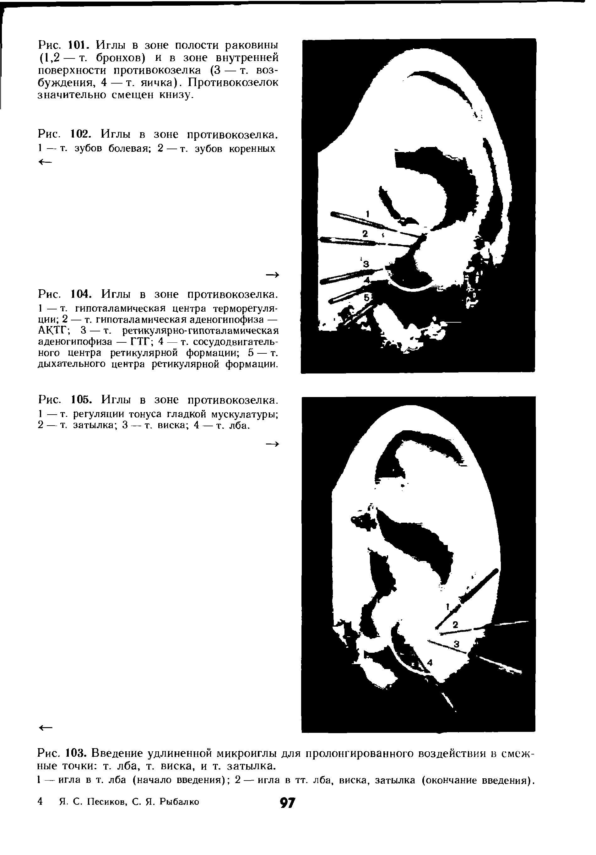 Рис. 102. Иглы в зоне противокозелка. 1 — т. зубов болевая 2 — т. зубов коренных...