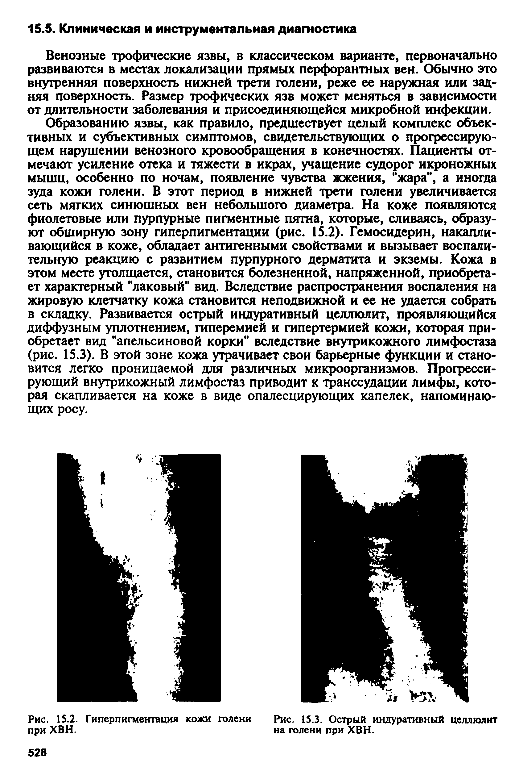 Рис. 15.2. Гиперпигментация кожи голени Рис. 15.3. Острый индуративный целлюлит при ХВН. на голени при ХВН.