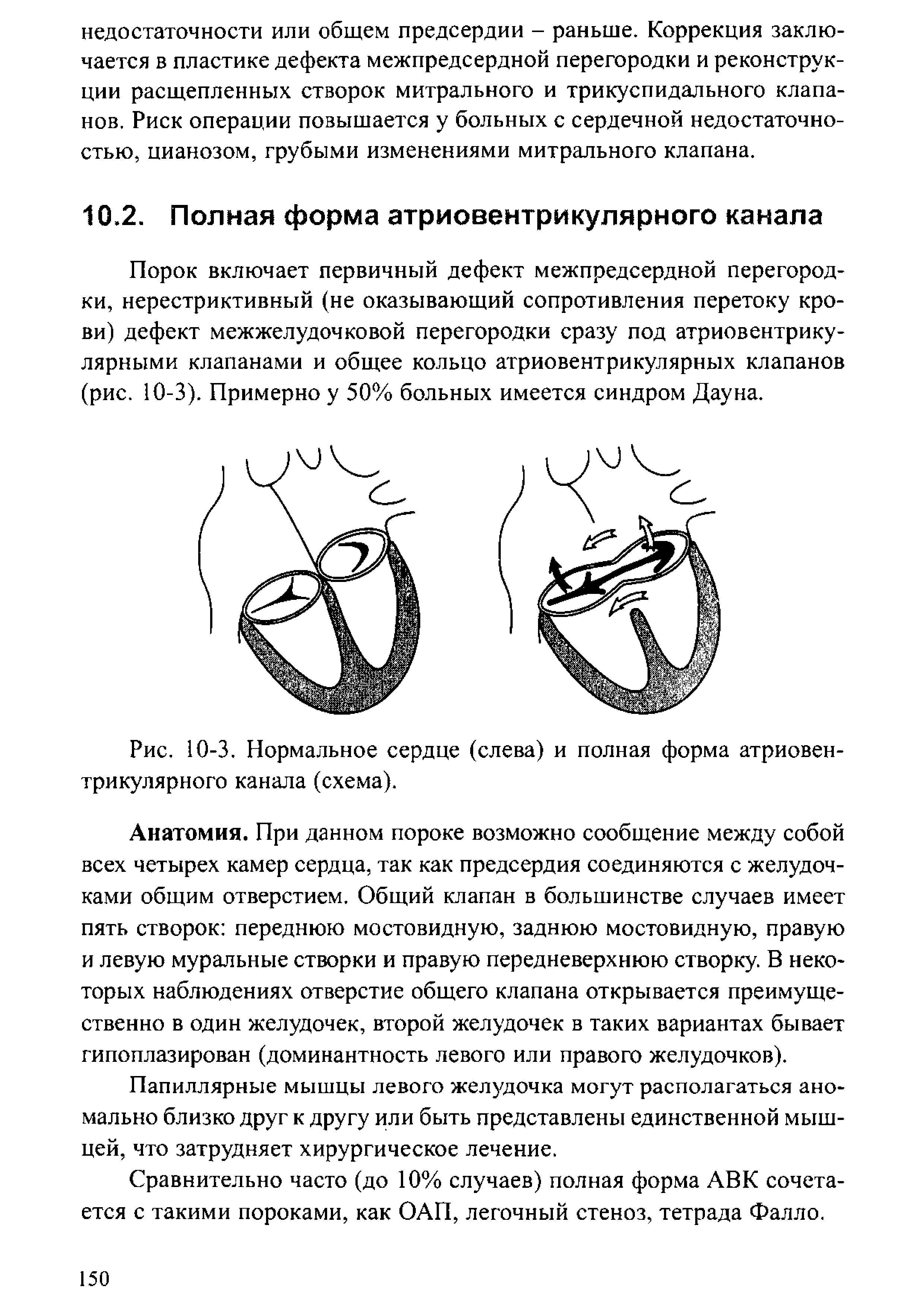 Рис. 10-3. Нормальное сердце (слева) и полная форма атриовентрикулярного канала (схема).