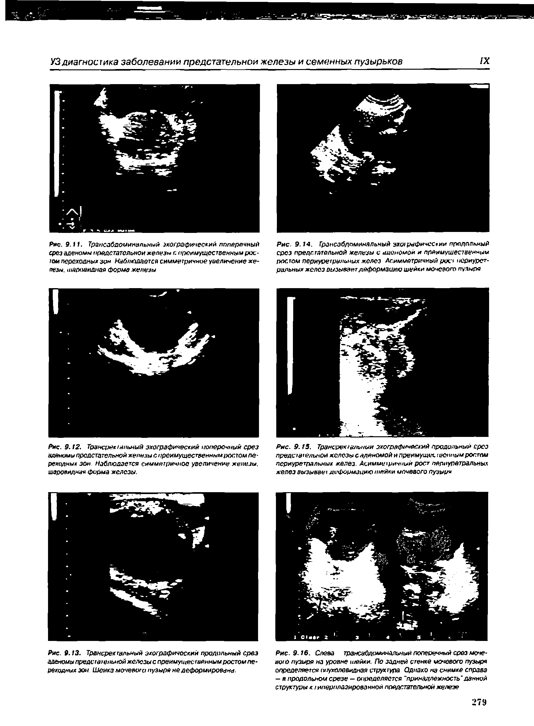 Рис. 9.14. Грансабдоминяльный зхотрафнчесхии птюдопьмый срез предстательной железы с аденомой и преимущественны ростом периуретрвльных желез Асимметричный рос юриурет-ральных желоз вызывает деформацию шейки мочевого пузыря...
