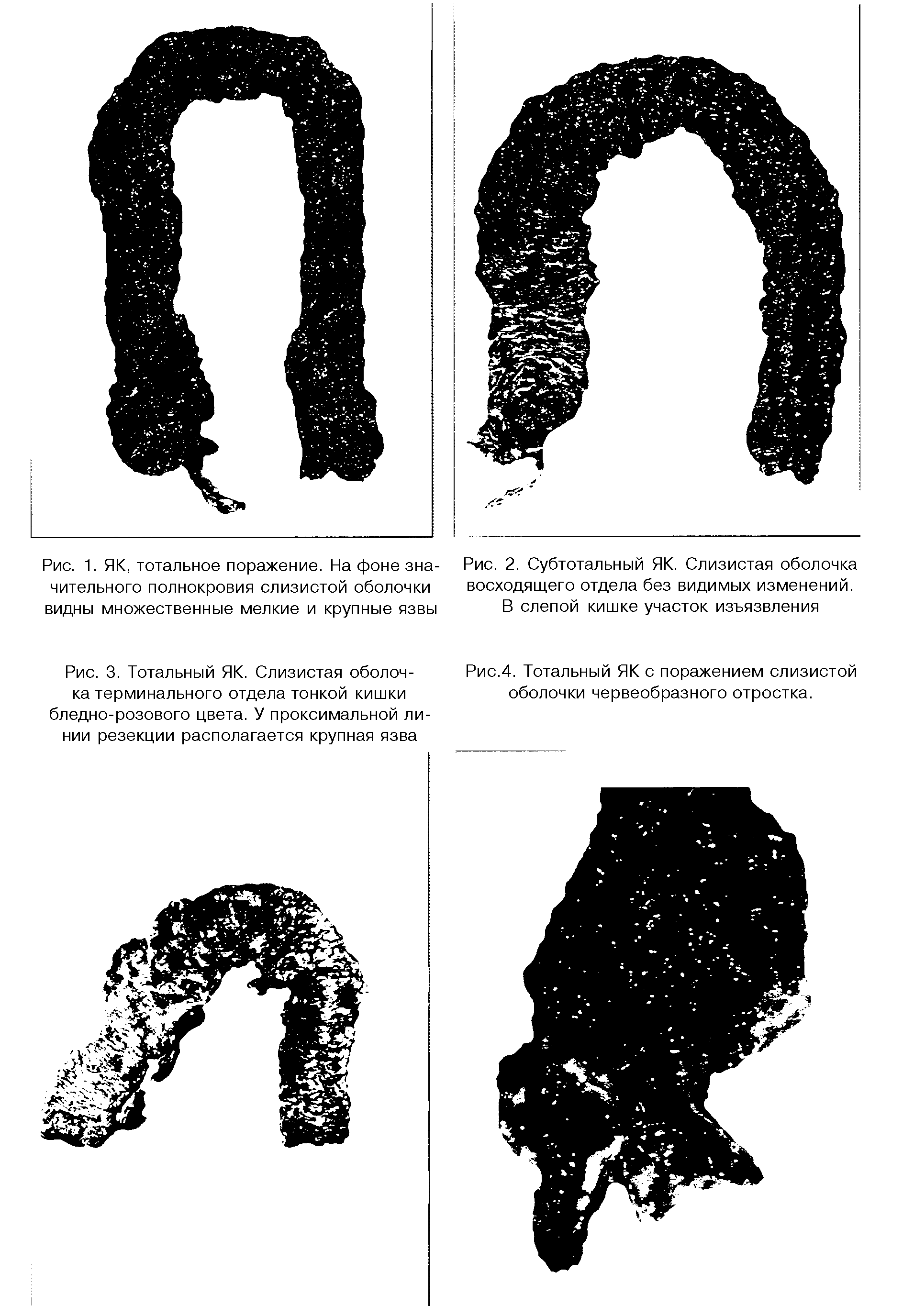 Рис.4. Тотальный ЯК с поражением слизистой оболочки червеобразного отростка.