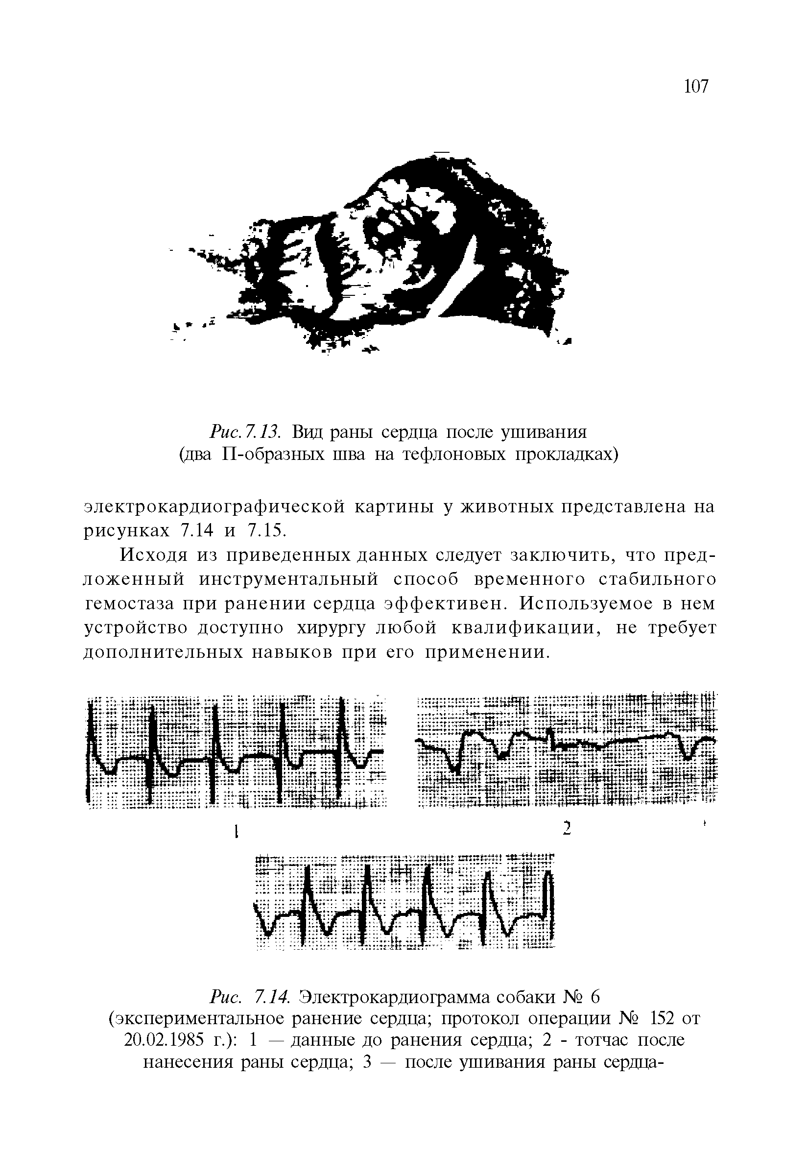 Рис. 7.14. Электрокардиограмма собаки № 6 (экспериментальное ранение сердца протокол операции № 152 от 20.02.1985 г.) 1 — данные до ранения сердца 2 - тотчас после нанесения раны сердца 3 — после ушивания раны сердца-...