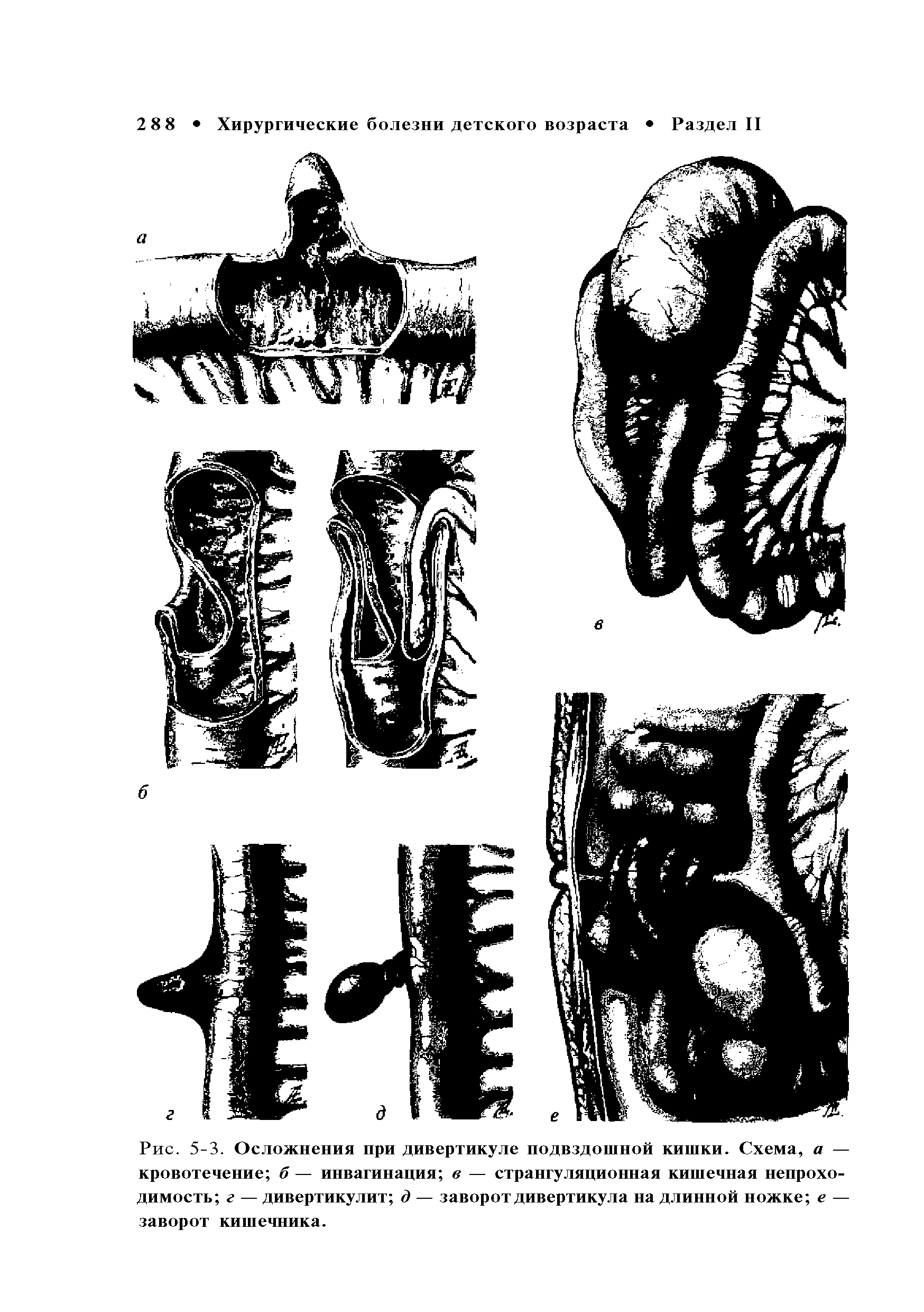 Рис. 5-3. Осложнения при дивертикуле подвздошной кишки. Схема, а — кровотечение б — инвагинация в — странгуляционная кишечная непроходимость г — дивертикулит д — заворот дивертикула на длинной ножке е — заворот кишечника.