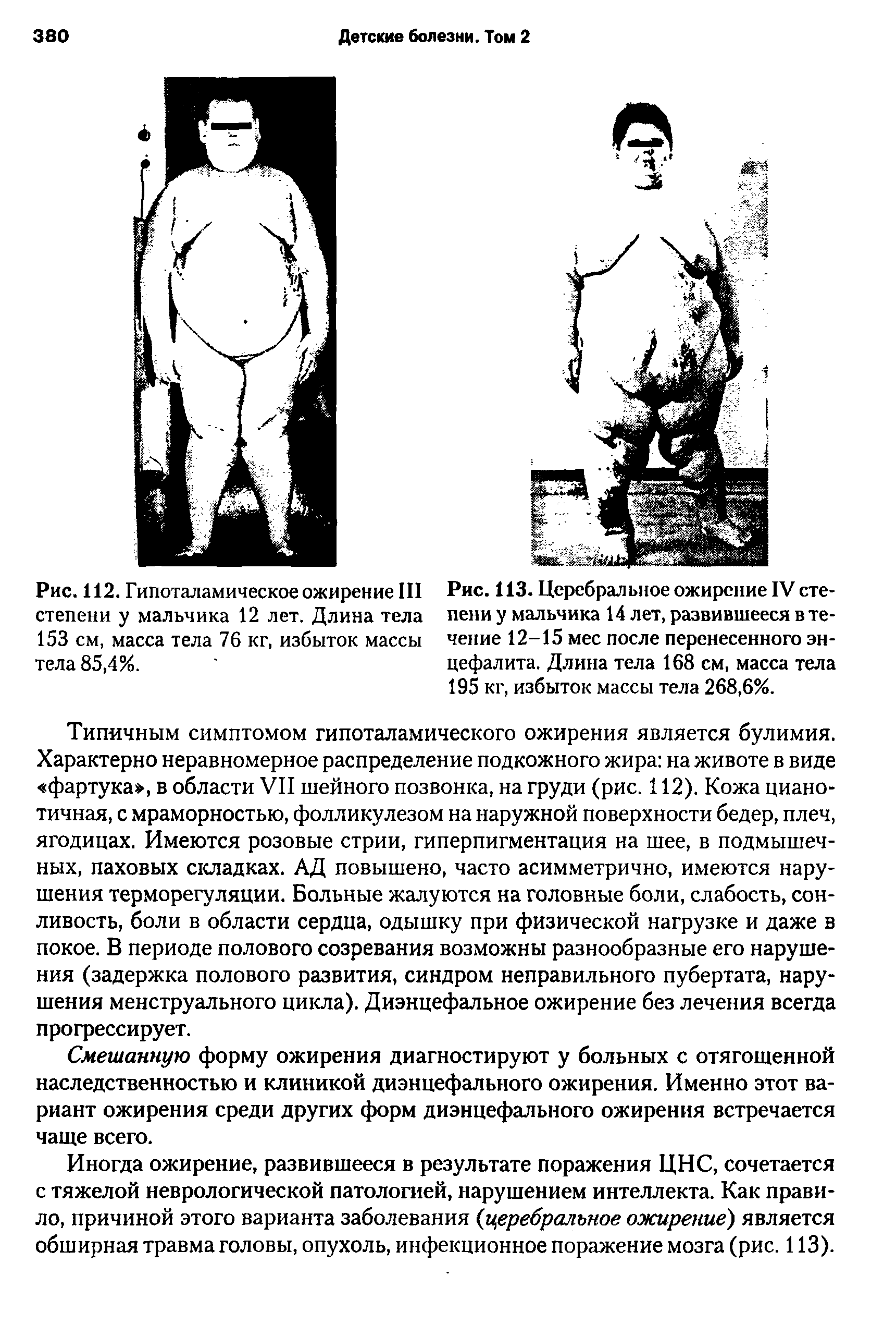 Рис. ИЗ. Церебральное ожирение IV степени у мальчика 14 лет, развившееся в течение 12-15 мес после перенесенного энцефалита. Длина тела 168 см, масса тела 195 кг, избыток массы тела 268,6%.