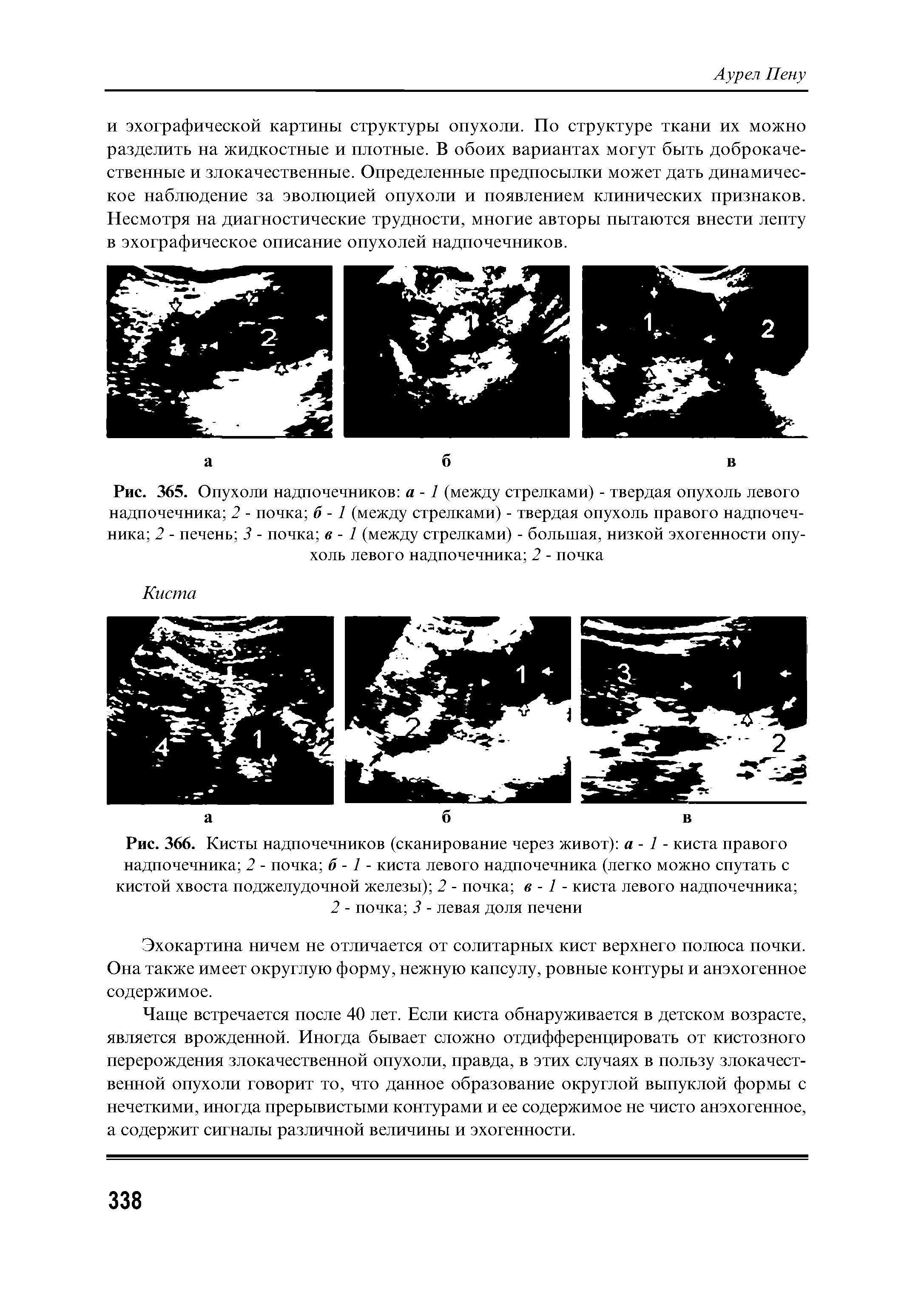 Рис. 366. Кисты надпочечников (сканирование через живот) а - 1 - киста правого надпочечника 2 - почка б -1 - киста левого надпочечника (легко можно спутать с кистой хвоста поджелудочной железы) 2 - почка в -1 - киста левого надпочечника ...