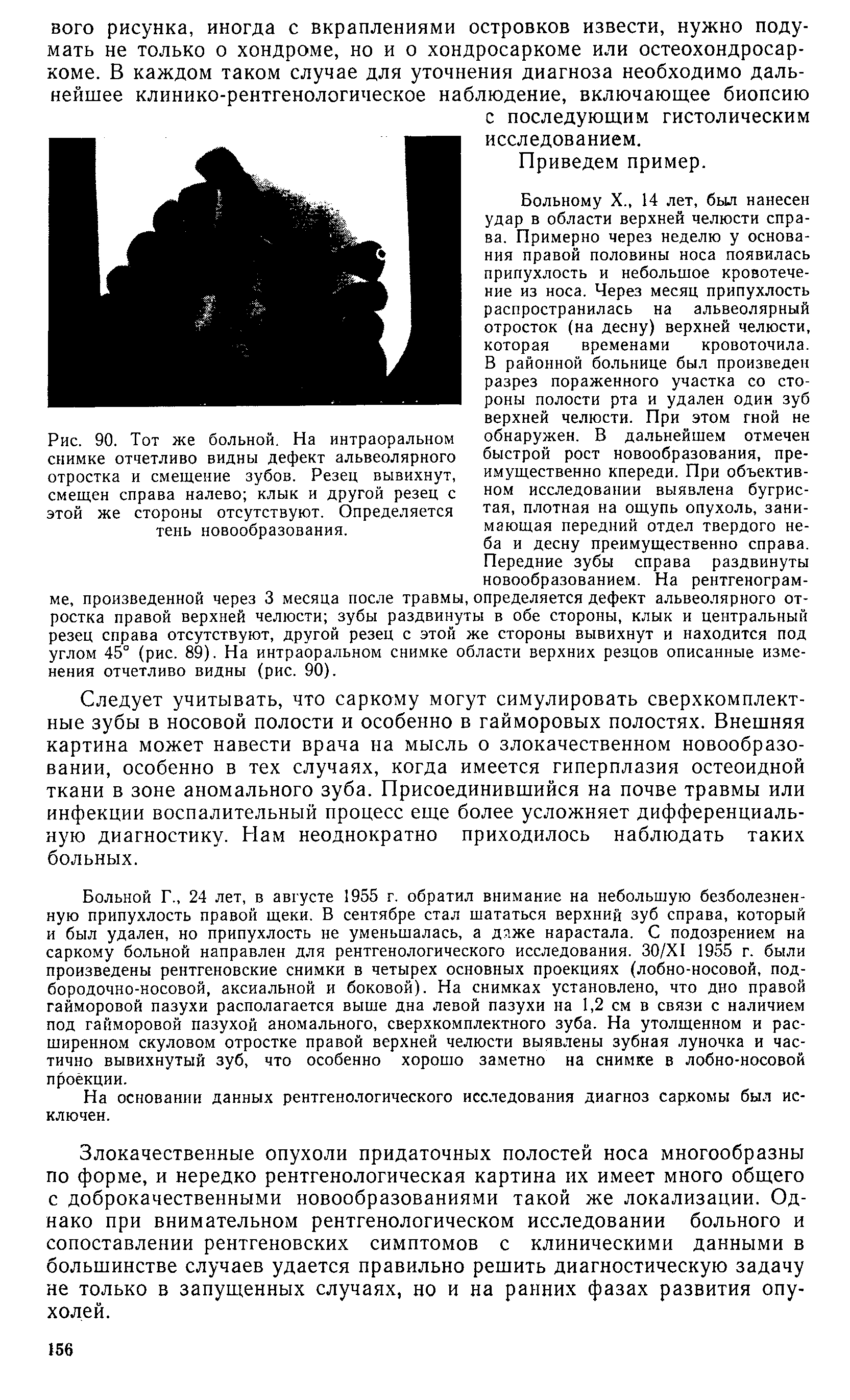 Рис. 90. Тот же больной. На интраоральном снимке отчетливо видны дефект альвеолярного отростка и смещение зубов. Резец вывихнут, смещен справа налево клык и другой резец с этой же стороны отсутствуют. Определяется тень новообразования.