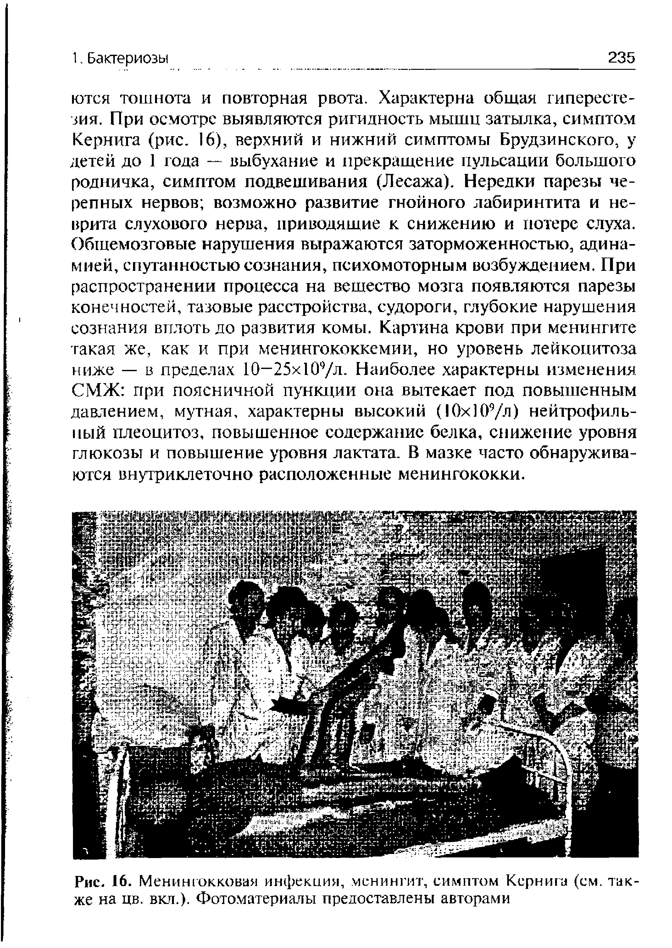 Рис. 16. Менингокковая инфекция, менингит, симптом Кернига (см. также на цв. вкл.). Фотоматериалы предоставлены авторами...