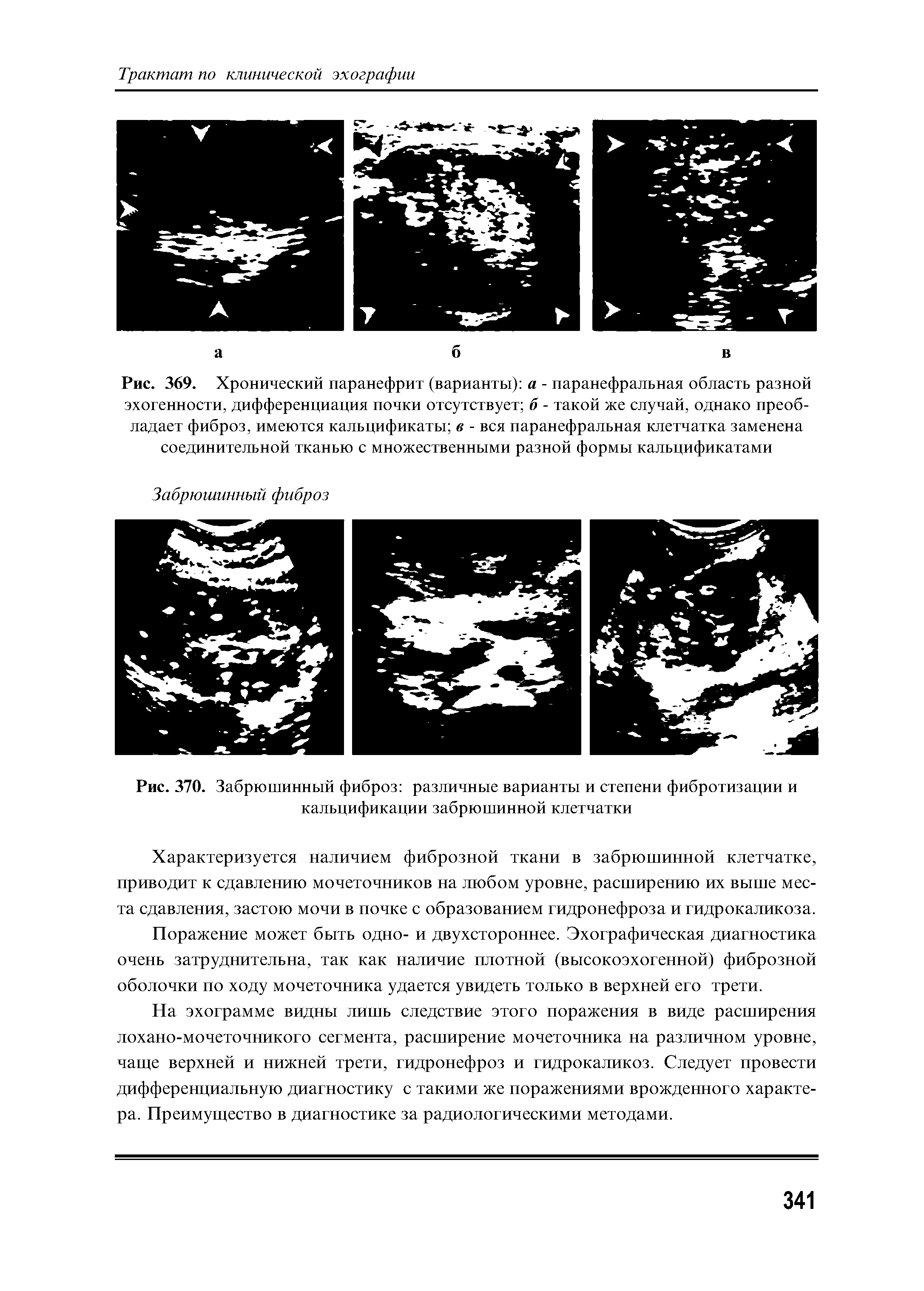 Рис. 370. Забрюшинный фиброз различные варианты и степени фибротизации и кальцификации забрюшинной клетчатки...
