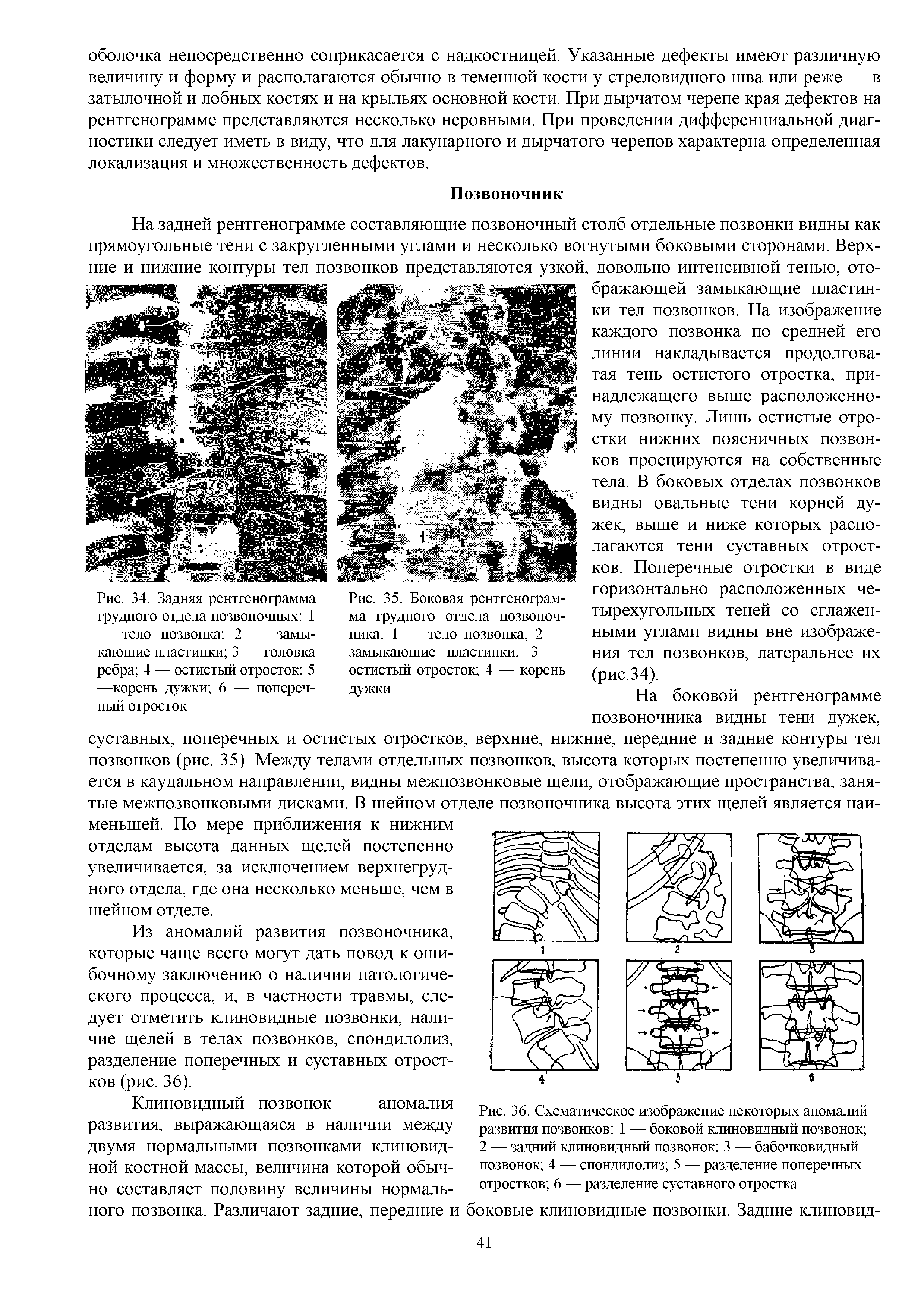Рис. 36. Схематическое изображение некоторых аномалий развития позвонков 1 — боковой клиновидный позвонок ...
