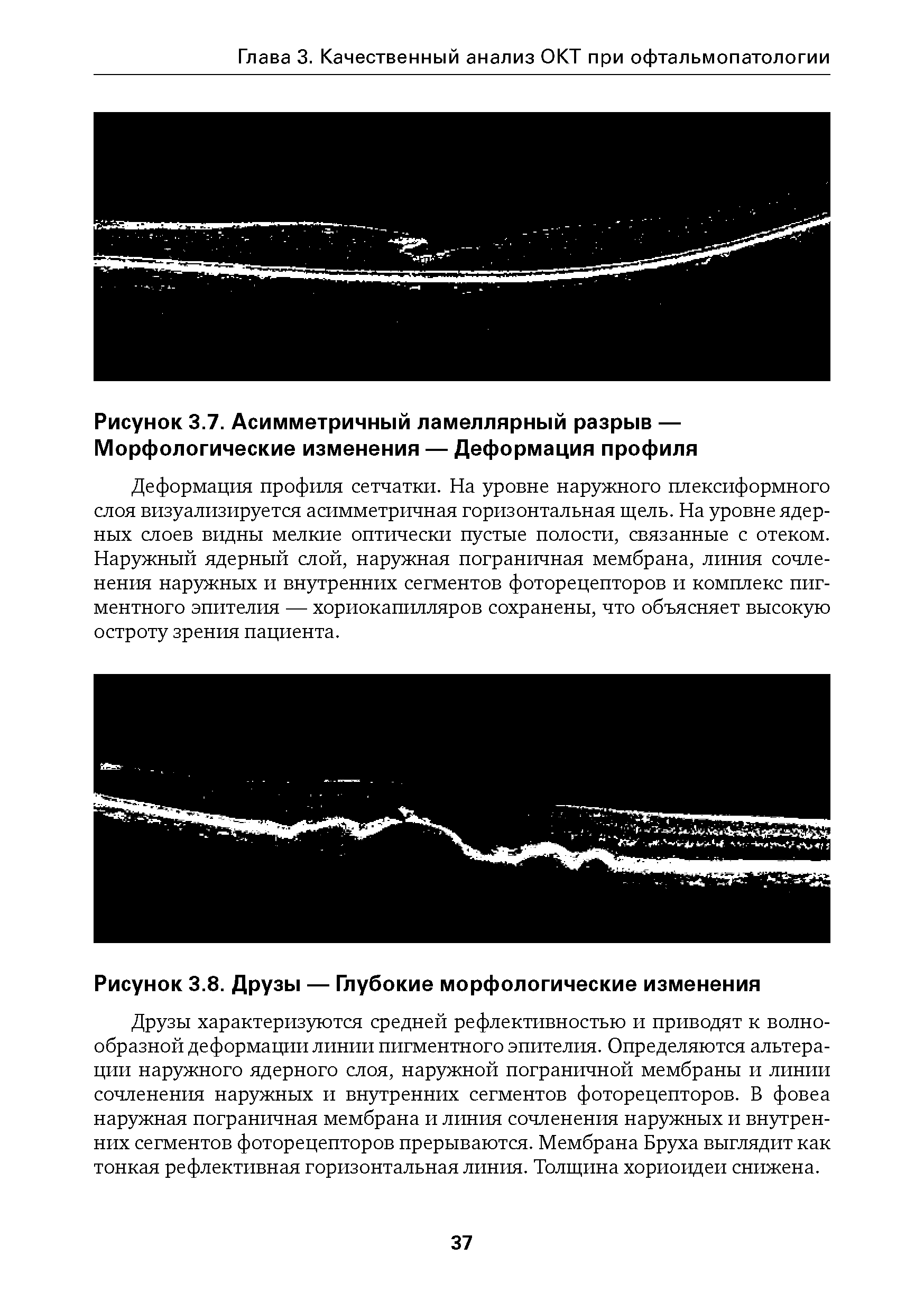 Рисунок 3.7. Асимметричный ламеллярный разрыв — Морфологические изменения — Деформация профиля...