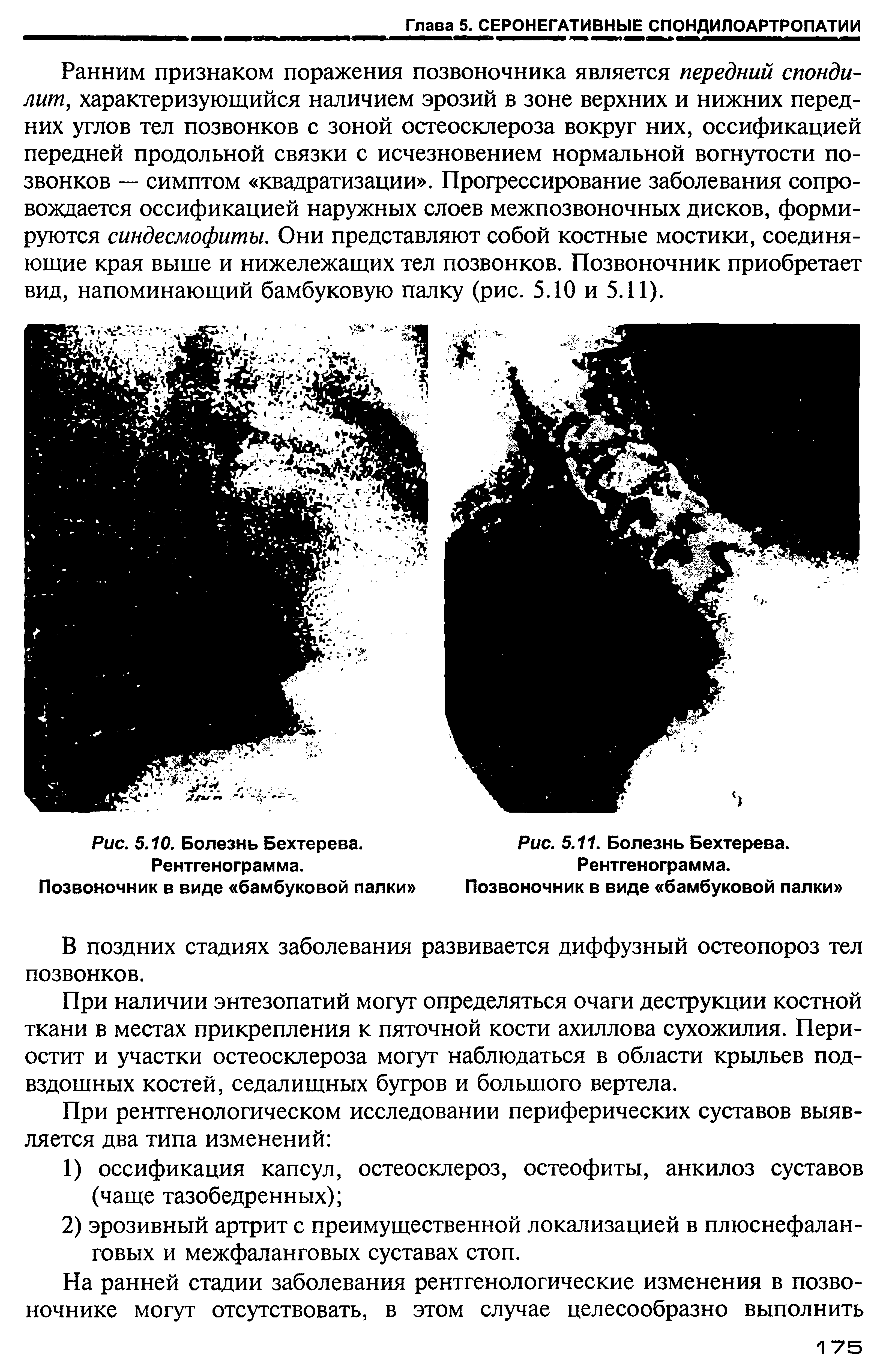 Рис. 5.10. Болезнь Бехтерева. Рентгенограмма. Позвоночник в виде бамбуковой палки ...