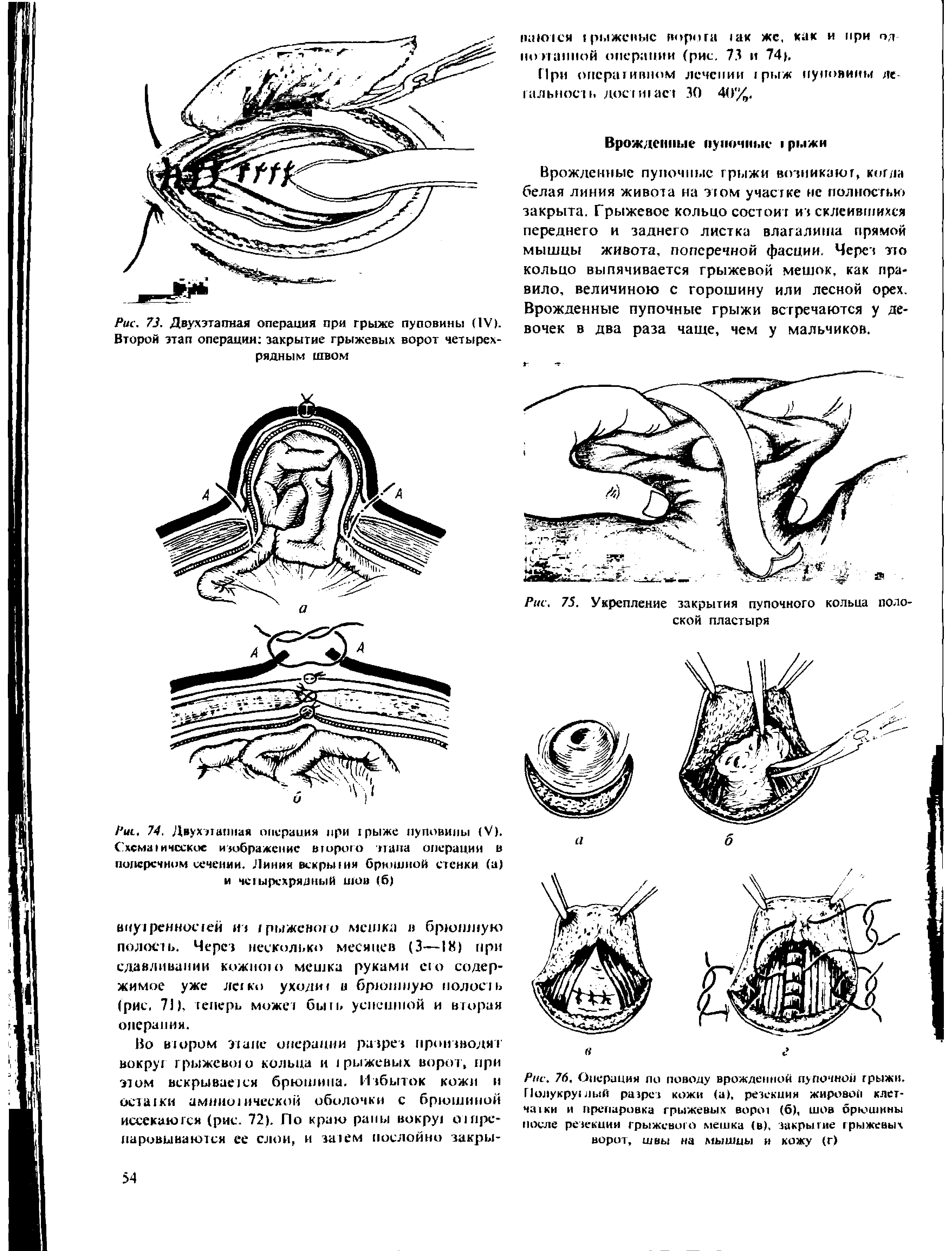 Рис. 76, Операция ли поводу врожден пой пупочной грыжи. Полукруглый разрез кожи (а), резекция жировой клетчатки и препаровка грыжевых ворси (6), шов брюшины после резекции грыжевого мешка (в), закрытие грыжевых ворот, швы на мышцы и кожу (г)...