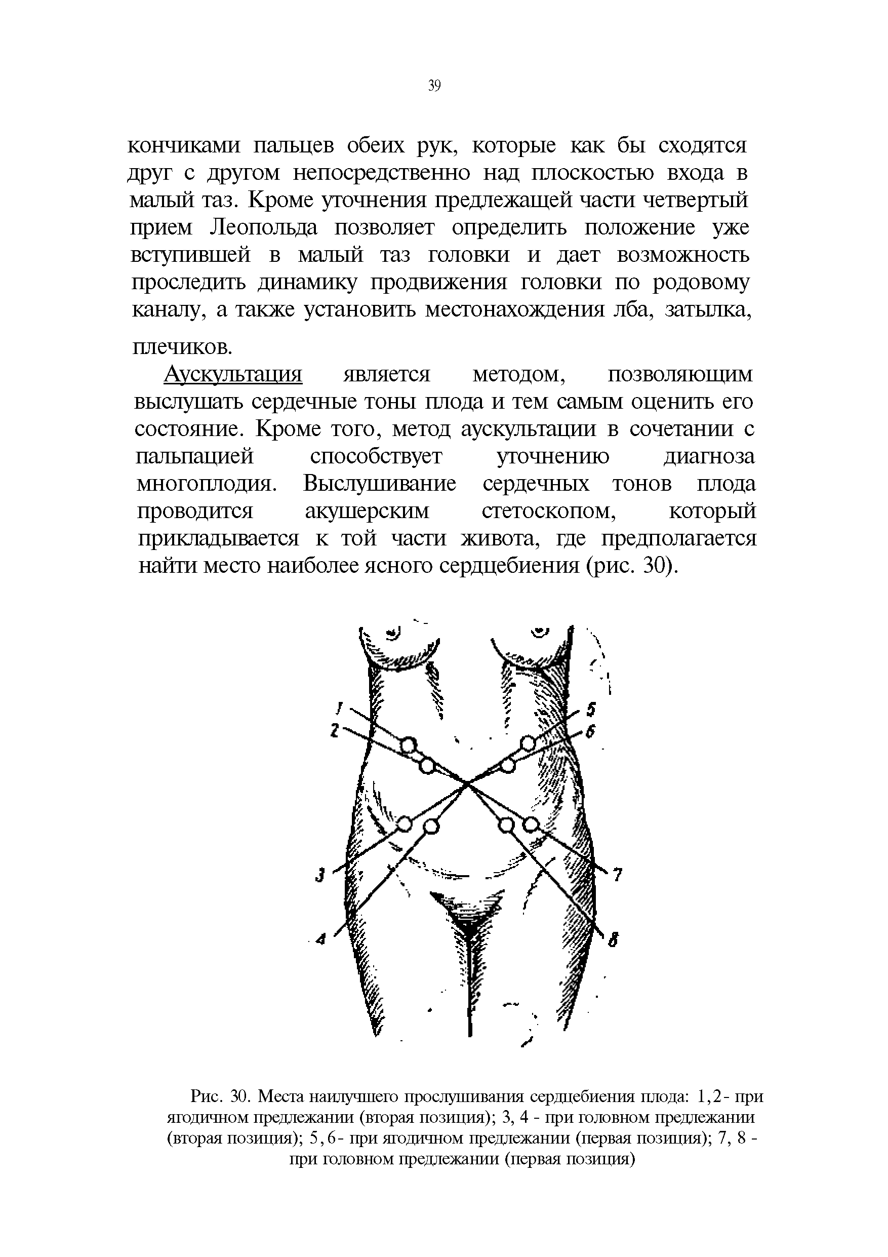 Рис. 30. Места наилучшего прослушивания сердцебиения плода 1,2- при ягодичном предлежании (вторая позиция) 3, 4 - при головном предлежании (вторая позиция) 5,6- при ягодичном предлежании (первая позиция) 7,8-при головном предлежании (первая позиция)...