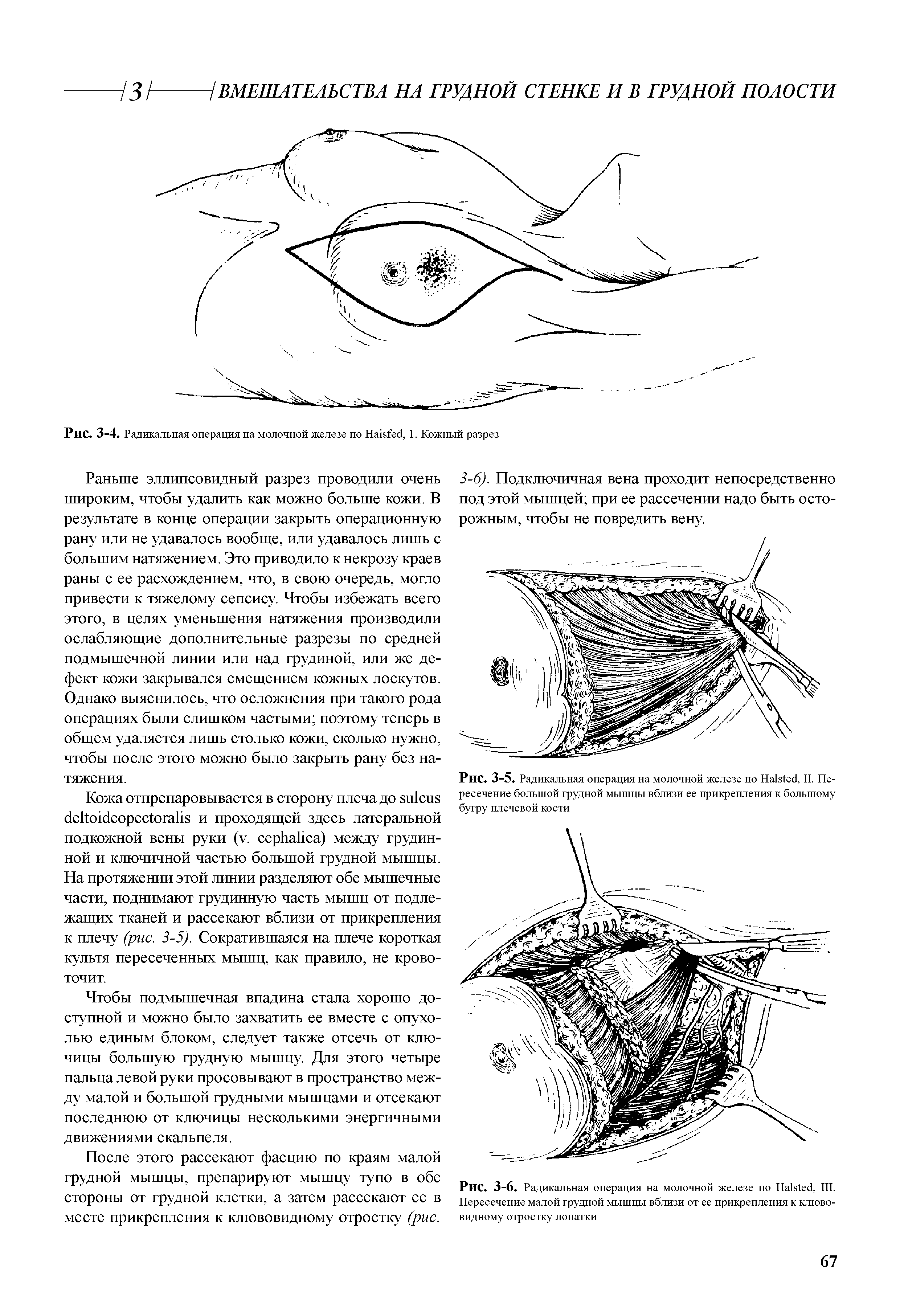 Рис. 3-5. Радикальная операция на молочной железе по На ес , II. Пересечение большой грудной мышцы вблизи ее прикрепления к большому бугру плечевой кости...