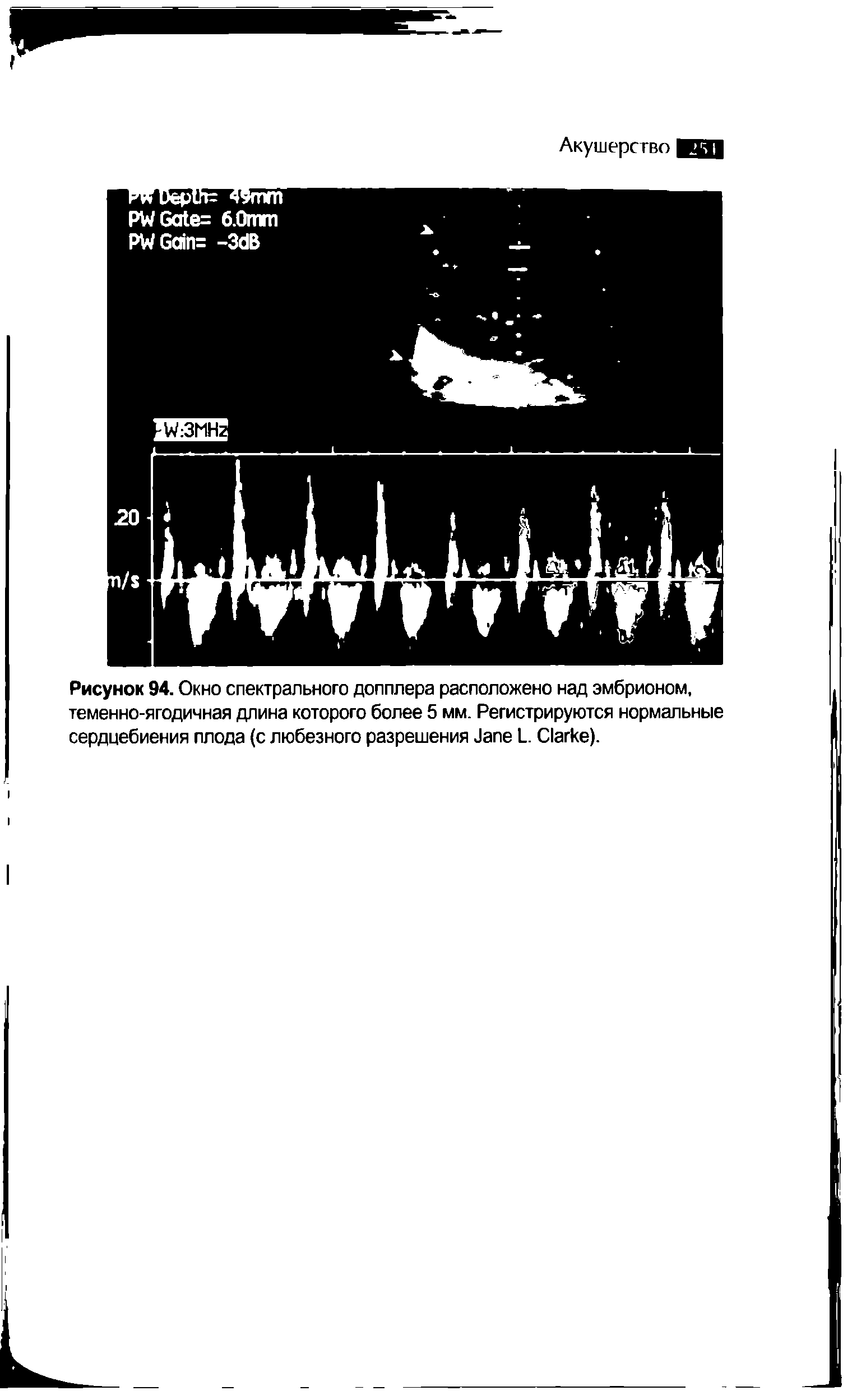 Рисунок 94. Окно спектрального допплера расположено над эмбрионом, теменно-ягодичная длина которого более 5 мм. Регистрируются нормальные сердцебиения плода (с любезного разрешения J L. C ).