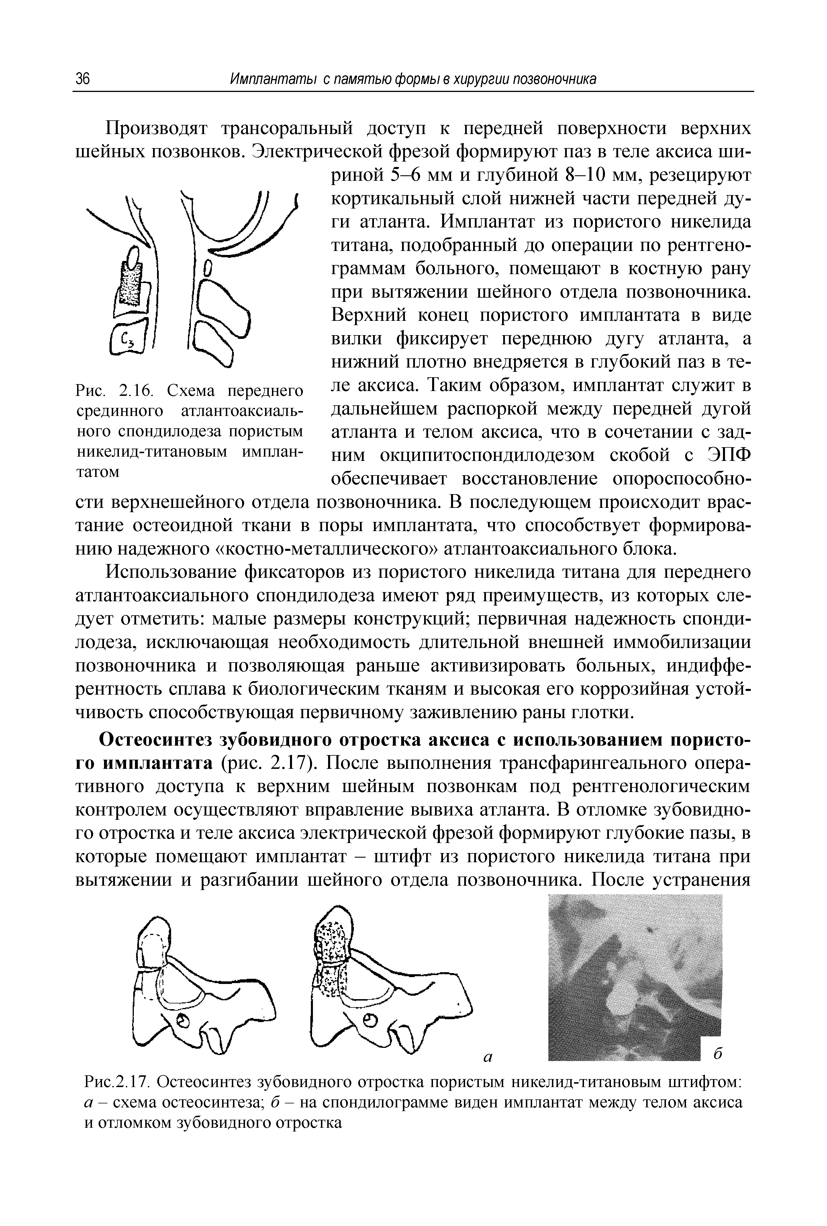 Рис.2.17. Остеосинтез зубовидного отростка пористым никелид-титановым штифтом а - схема остеосинтеза б - на спондилограмме виден имплантат между телом аксиса и отломком зубовидного отростка...