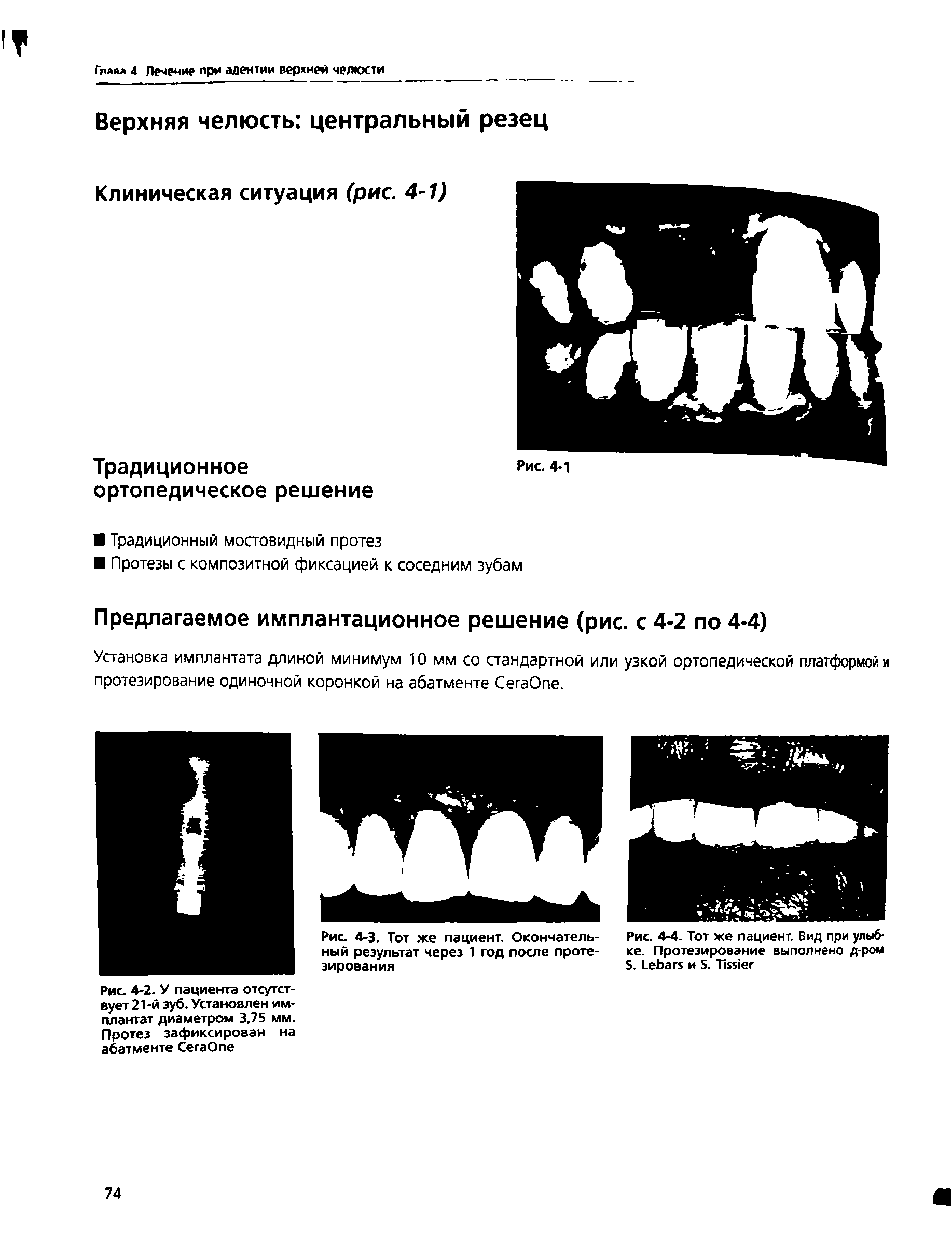 Рис. 4-2. У пациента отсутствует 21-й зуб. Установлен имплантат диаметром 3,75 мм. Протез зафиксирован на абатменте СегаОпе...