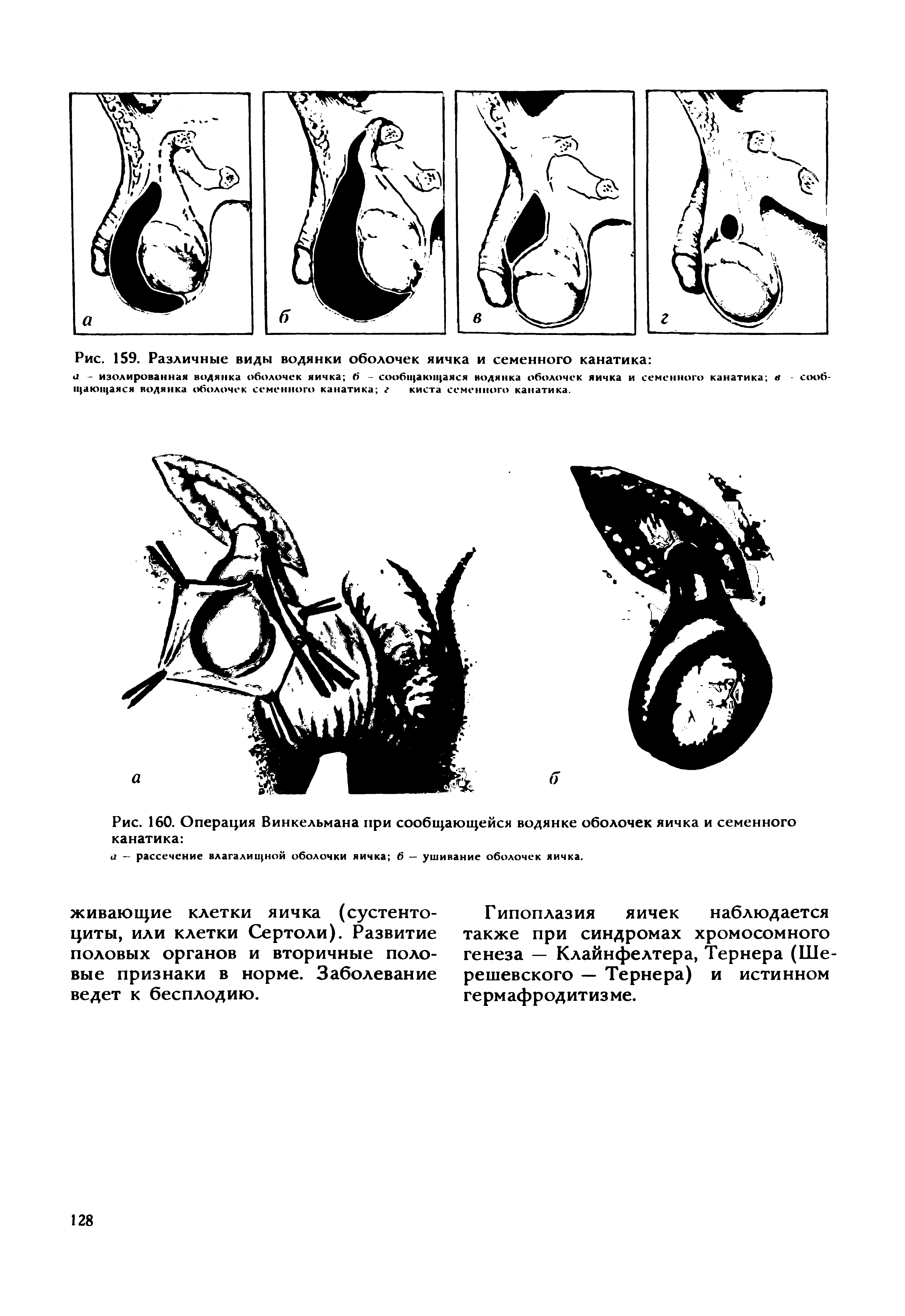 Рис. 160. Операция Винкельмана при сообщающейся водянке оболочек яичка и семенного канатика ...