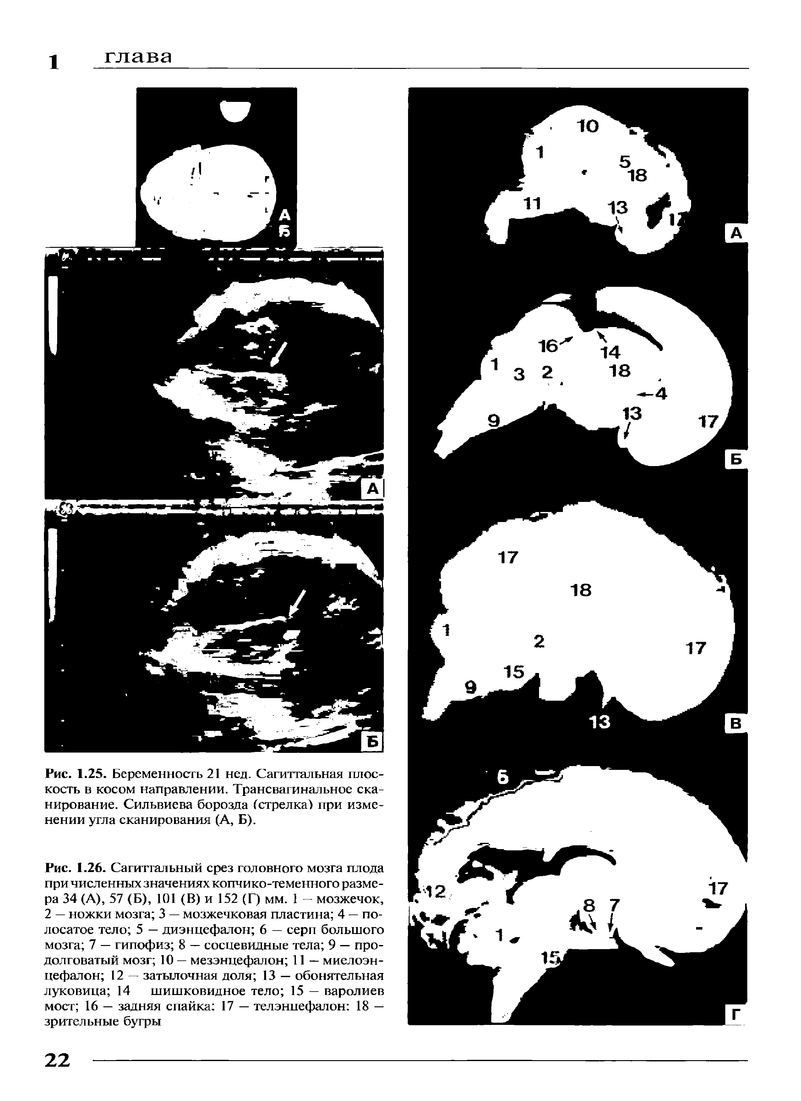 Рис. 1.25. Беременность 21 нед. Сагиттальная плоскость в косом направлении. Трансвагинальное сканирование. Сильвиева борозда (стрелка) при изменении угла сканирования (А, Б).