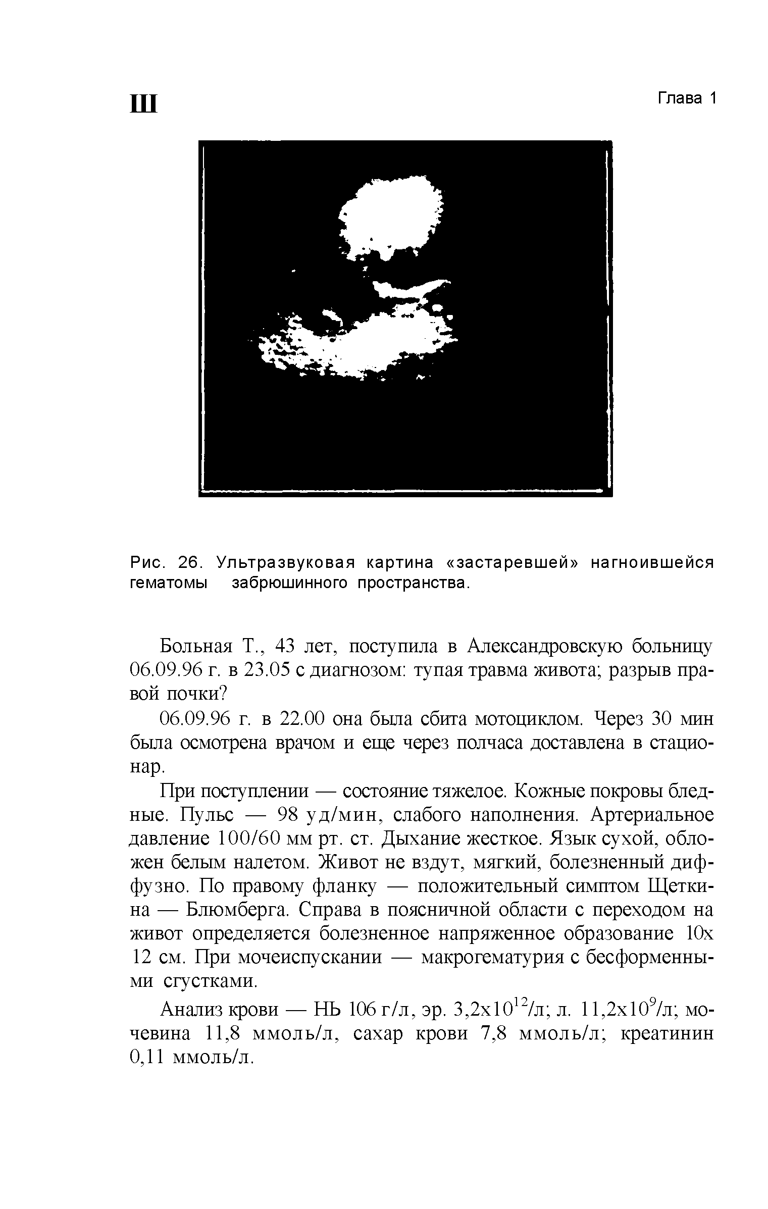 Рис. 26. Ультразвуковая картина застаревшей нагноившейся гематомы забрюшинного пространства.