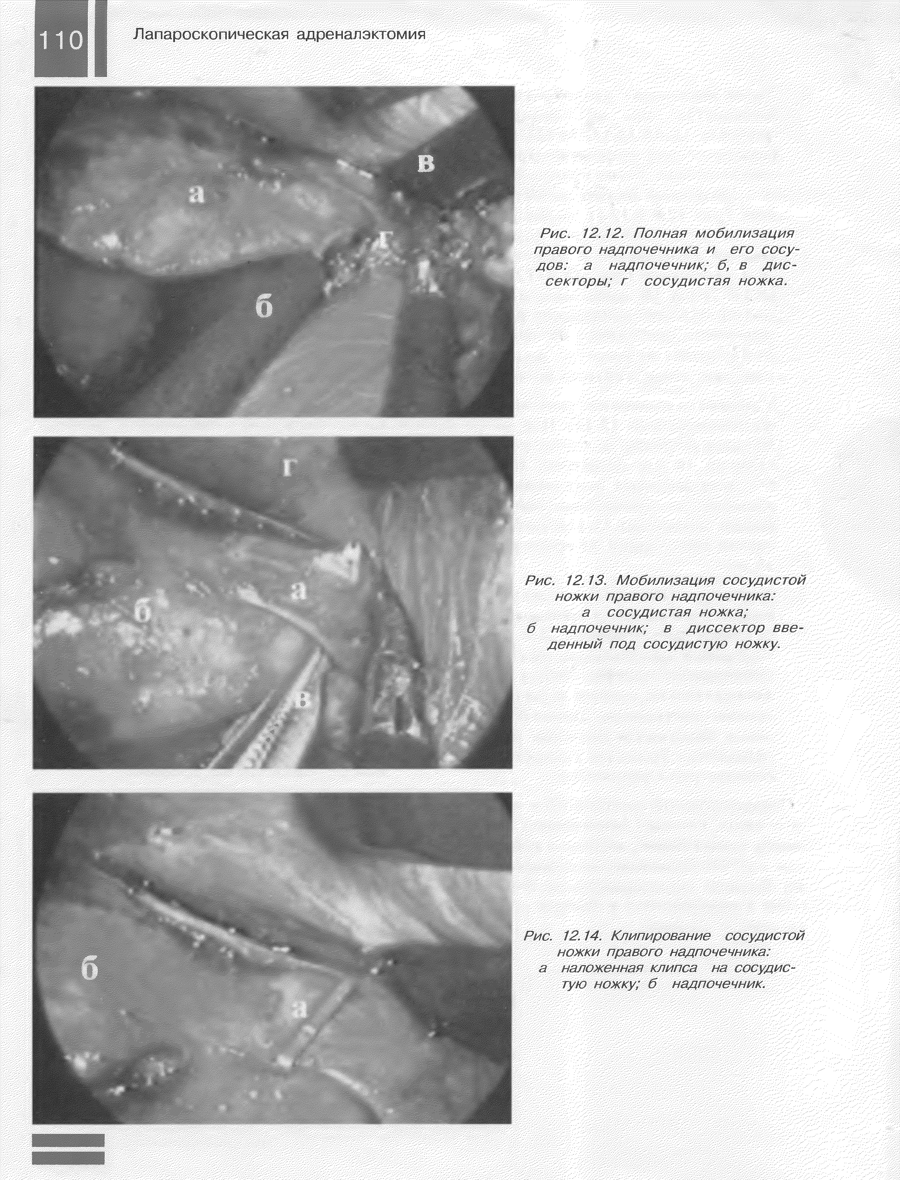 Рис. 12. 12. Полная мобилизация правого надпочечника и его сосу дов а надпочечник, б, в диссекторы г сосудистая ножка...