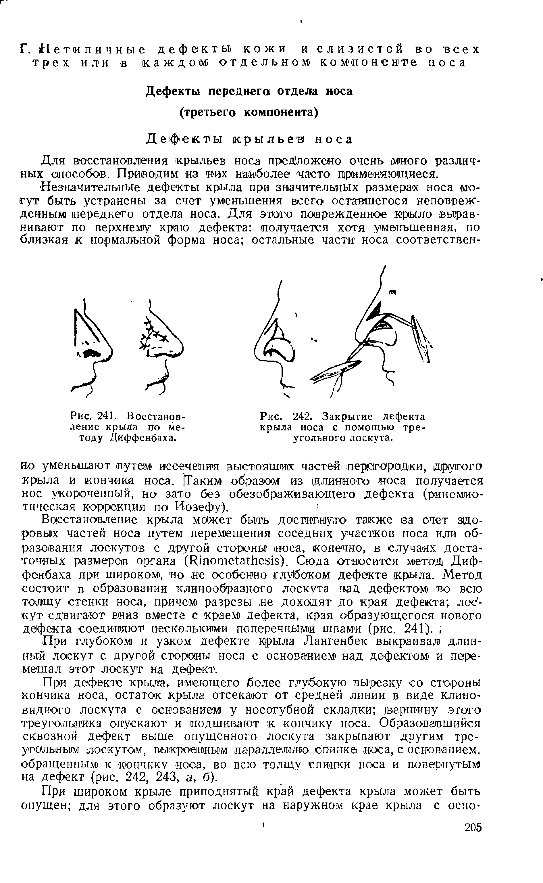 Рис. 242. Закрытие дефекта крыла носа с помощью треугольного лоскута.