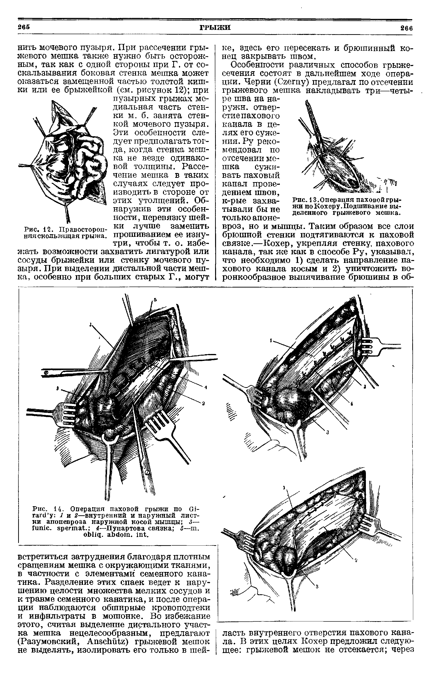 Рис. 14. Операция паховой грыжи по G - 1 и 2—внутренний и наружный листки апоневроза наружной косой мышцы з— , . 4—Пупартова связка 5—т. . . .