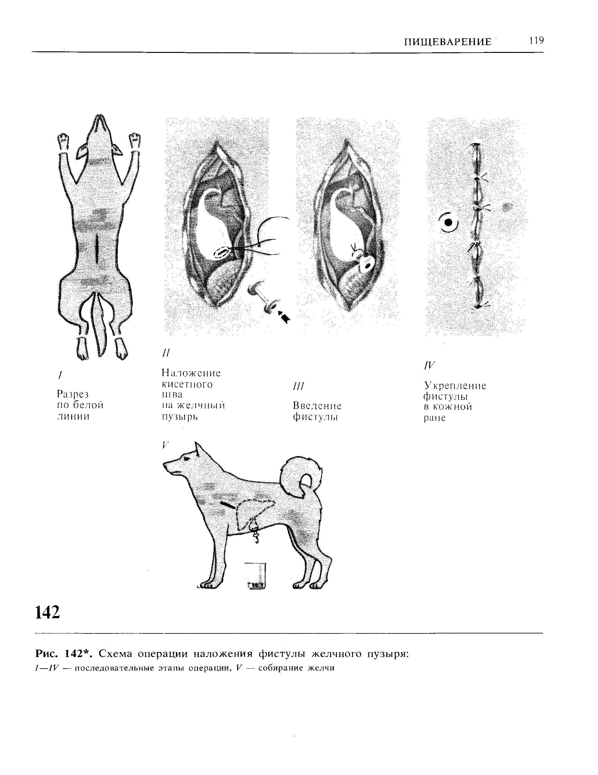 Рис. 142. Схема операции наложения фистулы желчного пузыря /—IV — последовательные этапы операции, V — собирание желчи...