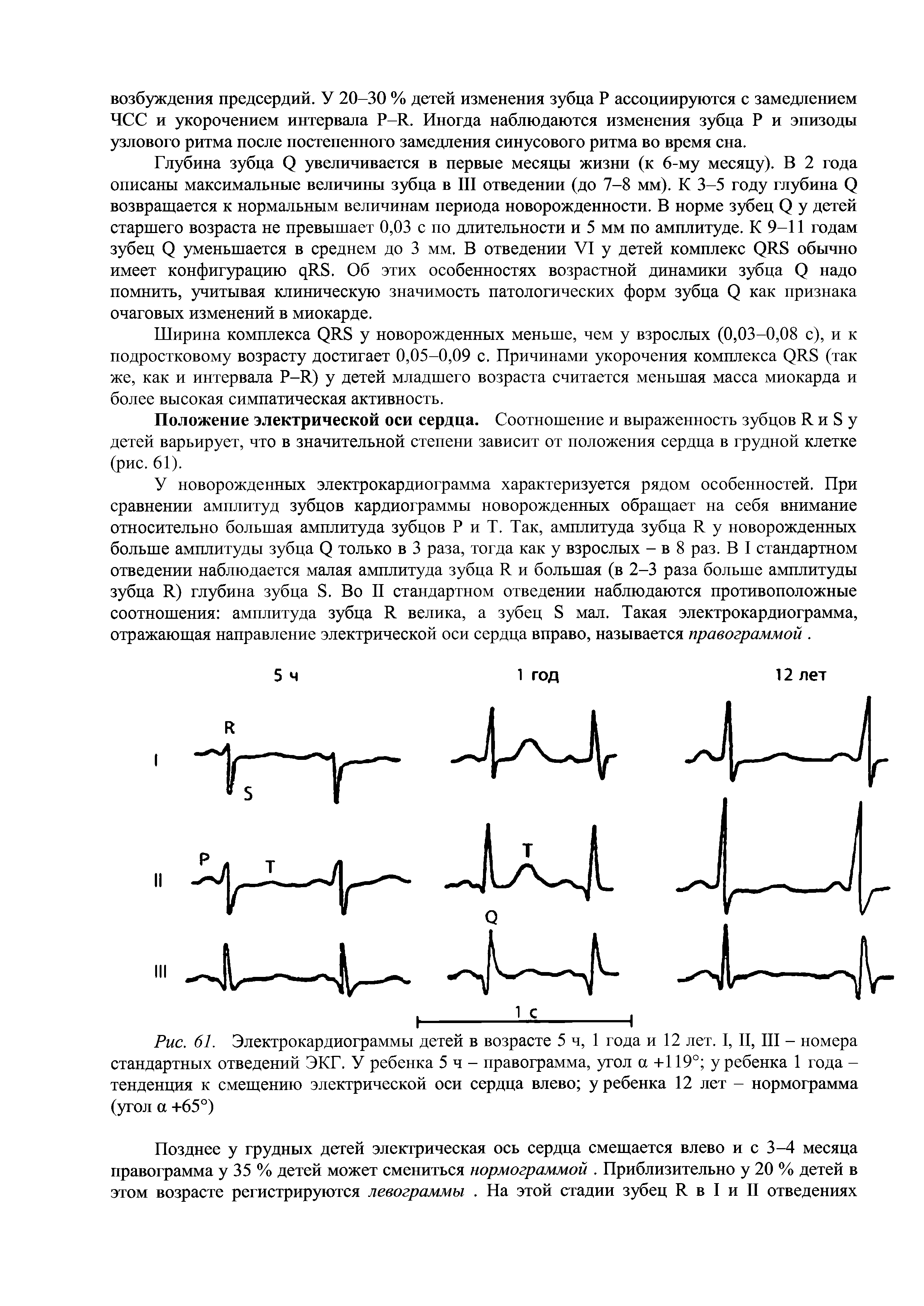 Рис. 61. Электрокардиограммы детей в возрасте 5 ч, 1 года и 12 лет. I, II, III - номера стандартных отведений ЭКГ. У ребенка 5ч- правограмма, угол а +119° у ребенка 1 года -тенденция к смещению электрической оси сердца влево у ребенка 12 лет - нормограмма (угол а +65°)...