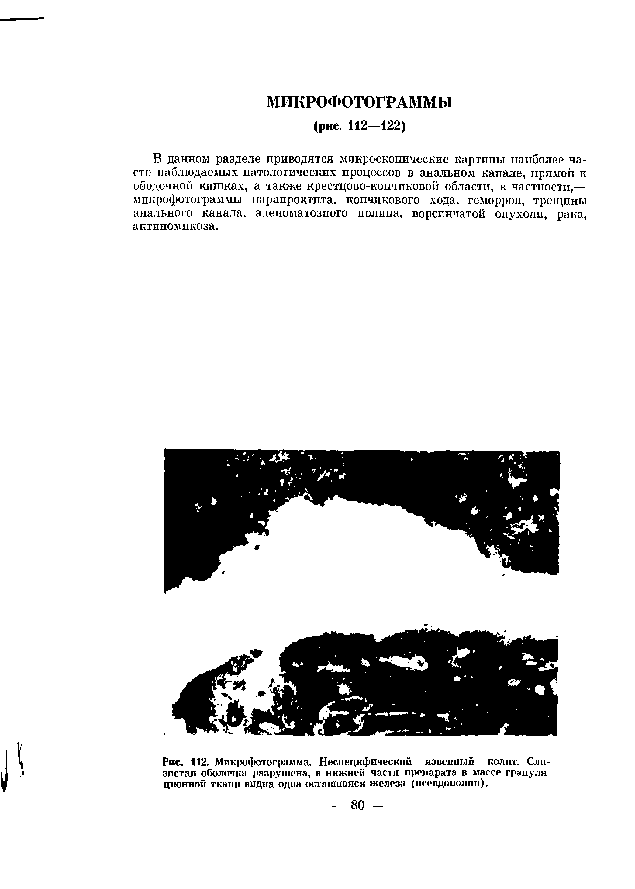 Рис. 112. Микрофотограмма. Неспецифическпй язвенный колит. Слизистая оболочка разрушена, в нижней части препарата в массе грануляционной ткани видна одна оставшаяся железа (псевдоподии).