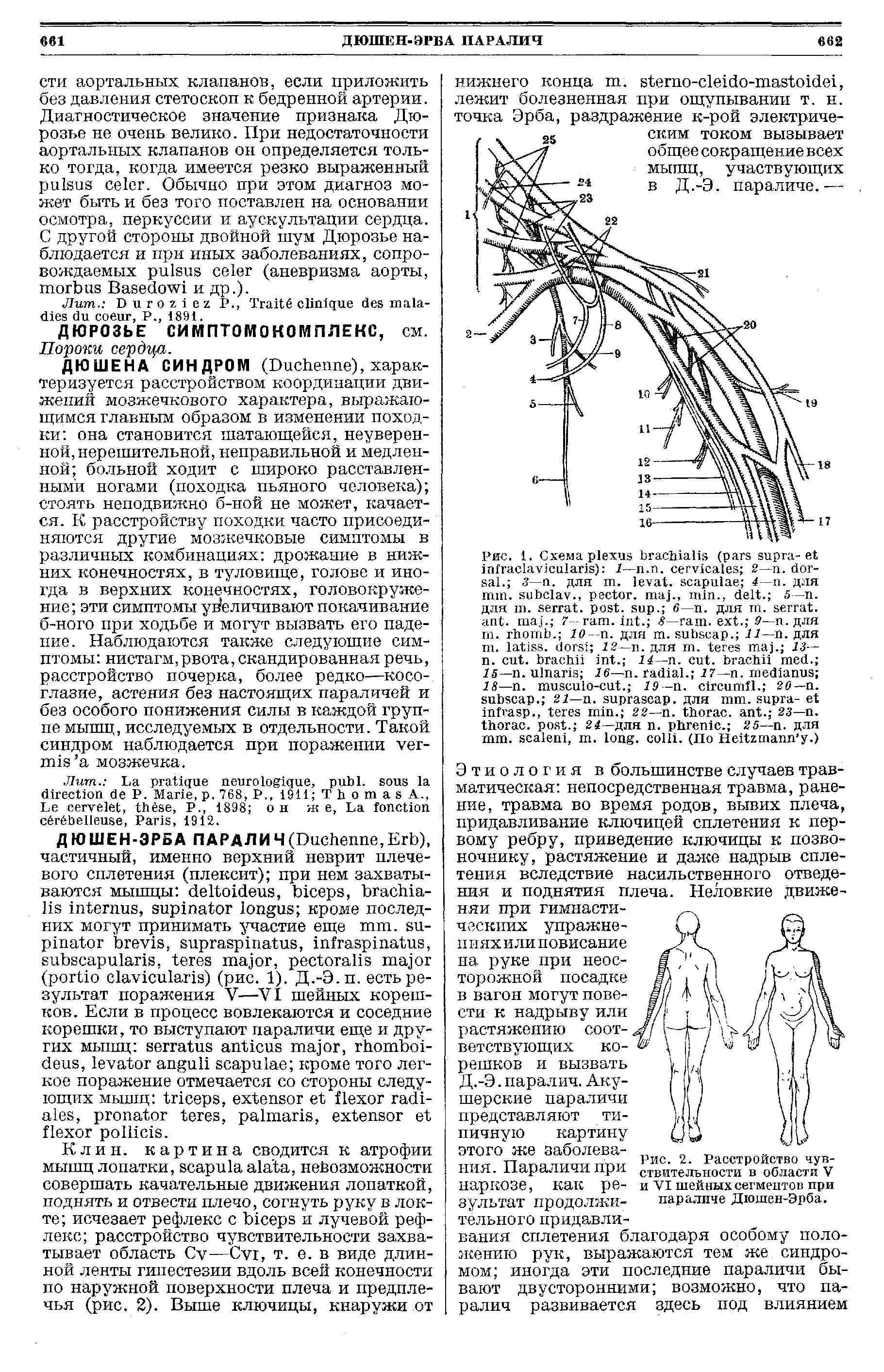 Рис. 2. Расстройство чувствительности в области V и VI шейных сегментов при параличе Дюшен-Эрба.