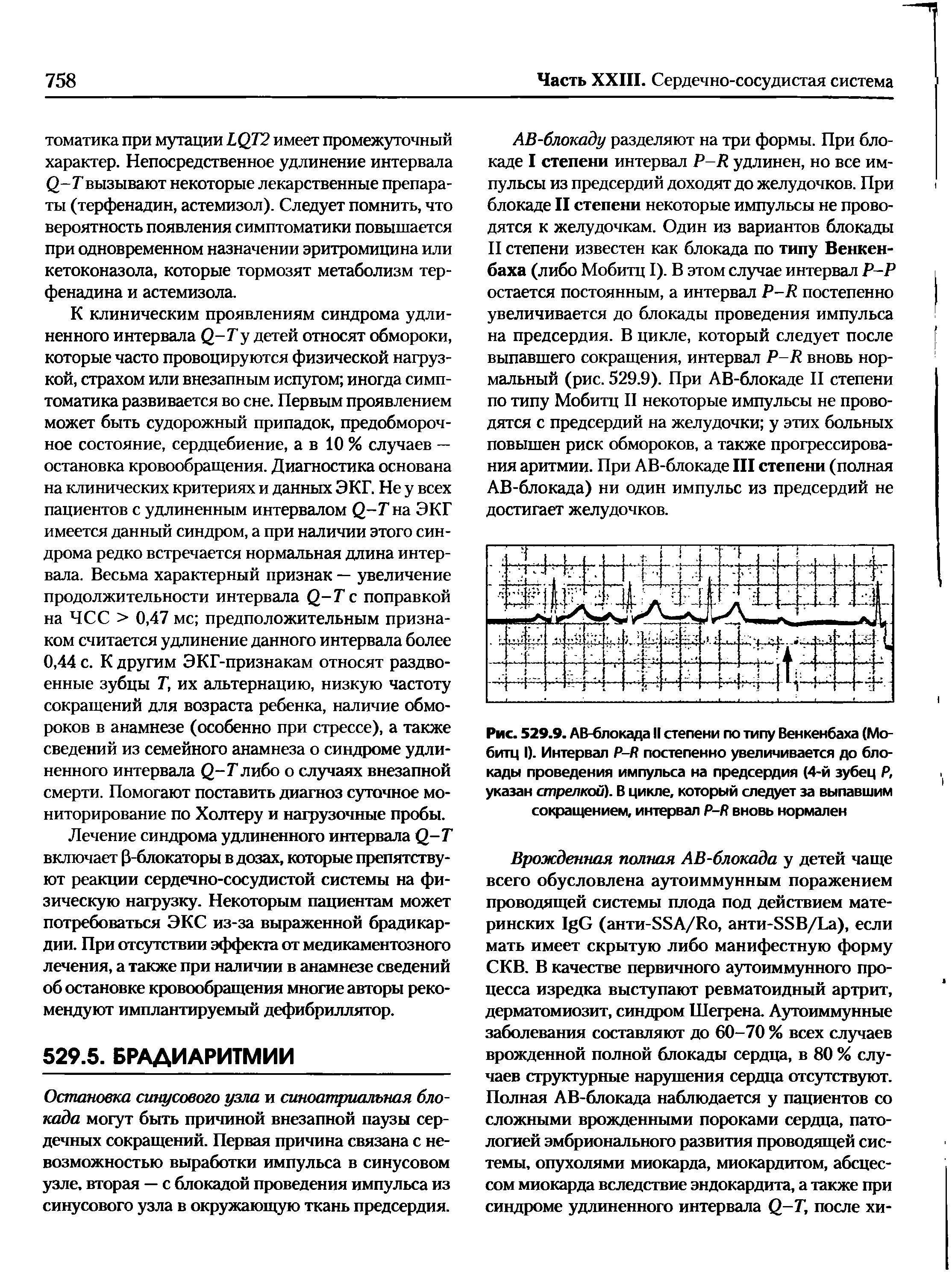 Рис. 529.9. АВ-блокада II степени по типу Венкенбаха (Мобитц I). Интервал Р-Я постепенно увеличивается до блокады проведения импульса на предсердия (4-й зубец Р, указан стрелкой). В цикле, который следует за выпавшим сокращением, интервал Р-А вновь нормален...