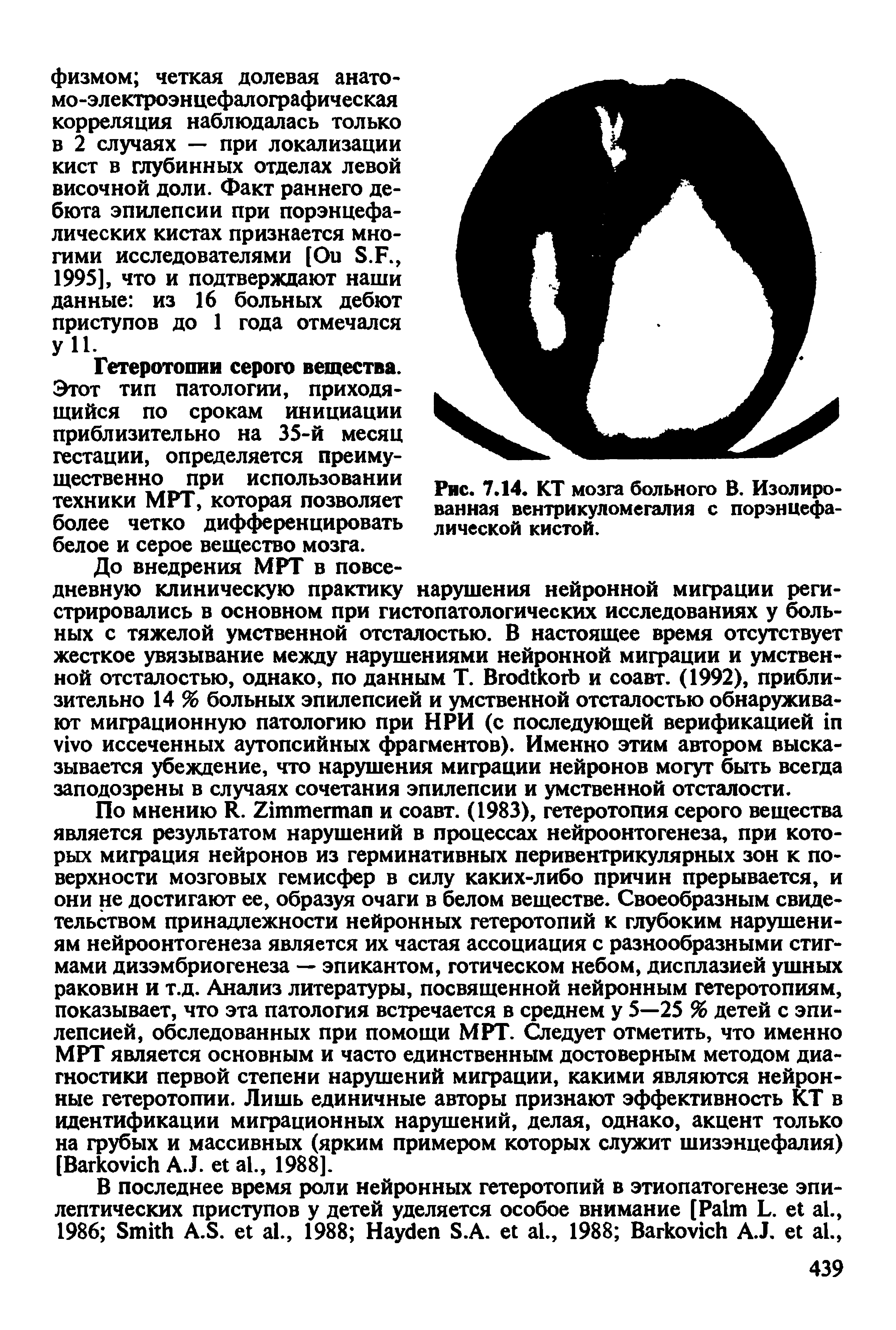 Рис. 7.14. КТ мозга больного В. Изолированная вентрикуломегалия с порэнцефалической кистой.