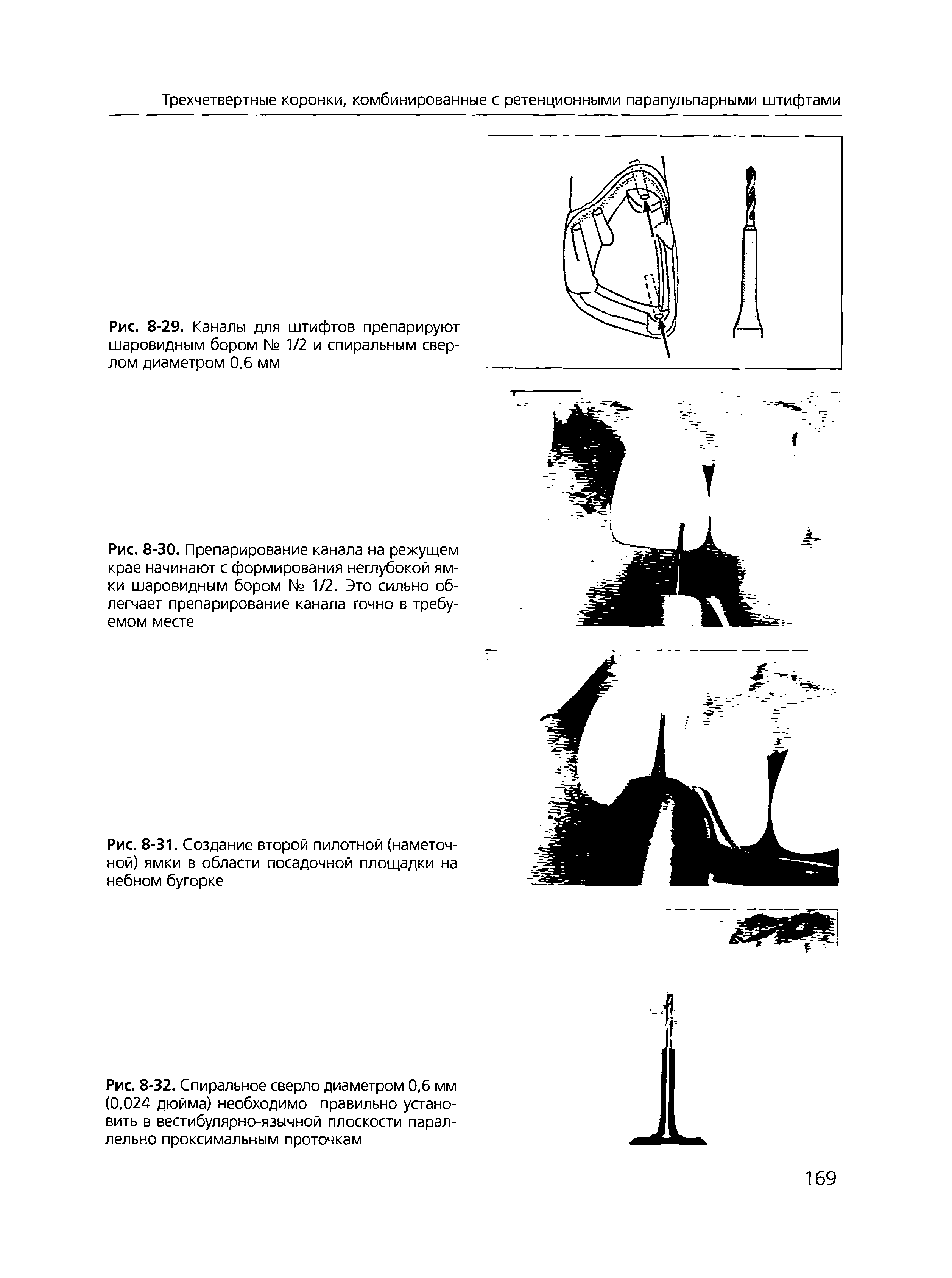 Рис. 8-29. Каналы для штифтов препарируют шаровидным бором № 1/2 и спиральным сверлом диаметром 0.6 мм...