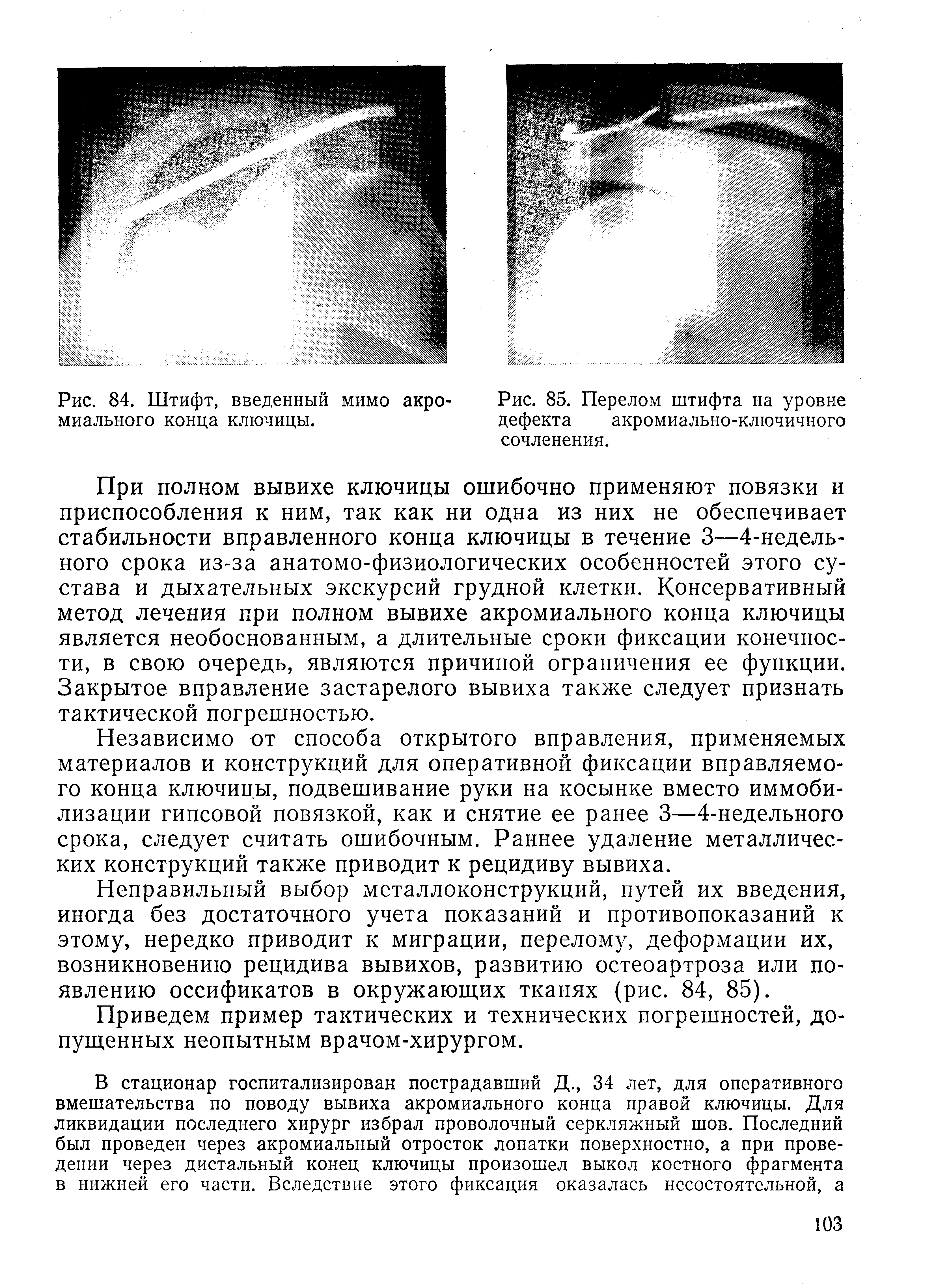 Рис. 85. Перелом штифта на уровне дефекта акромиально-ключичного сочленения.