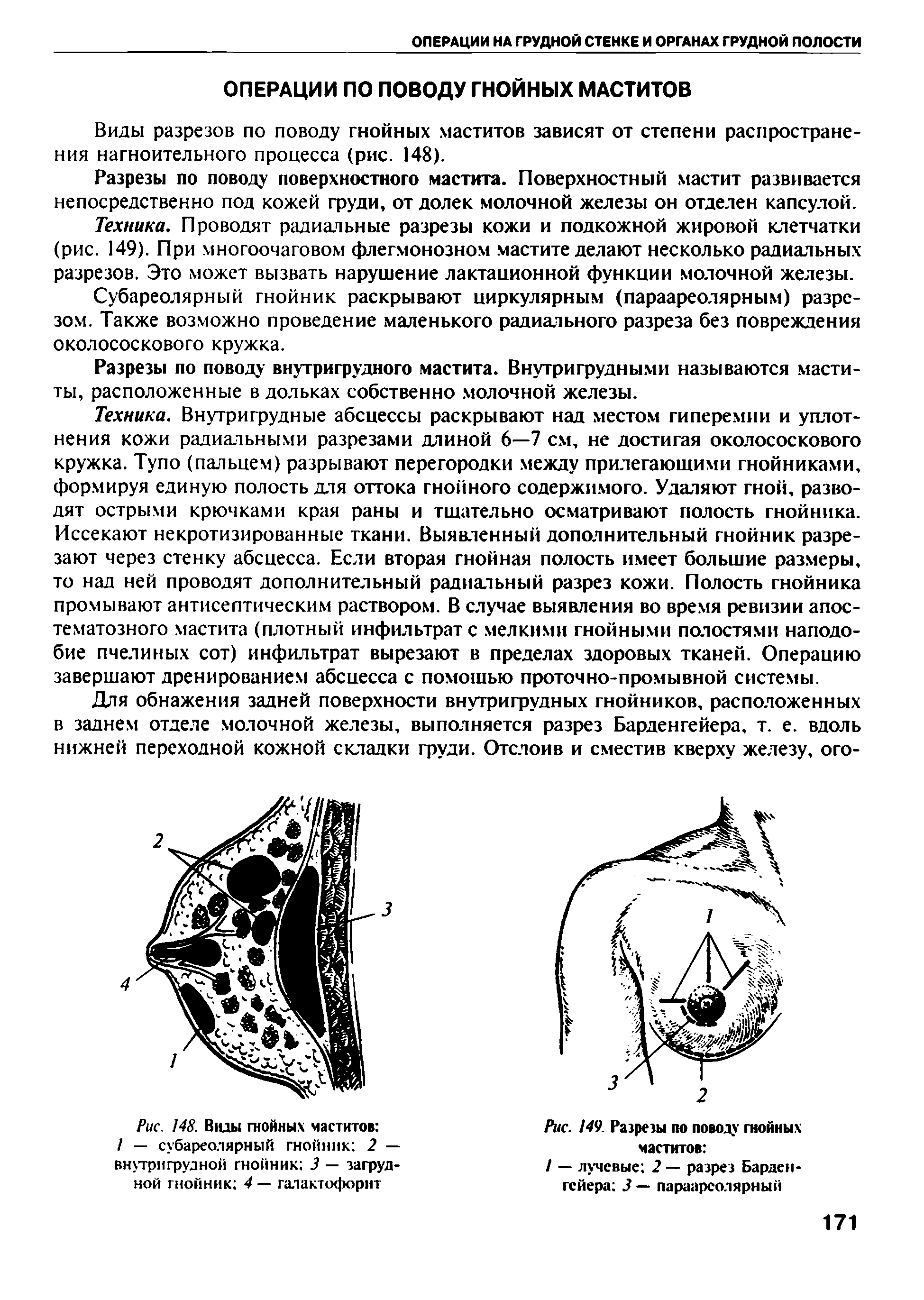 Рис. 148. Виды гнойных маститов / — субареолярный гнойник 2 — внугригрудной гнойник 3 — загруд-ной гнойник 4 — галактофорит...