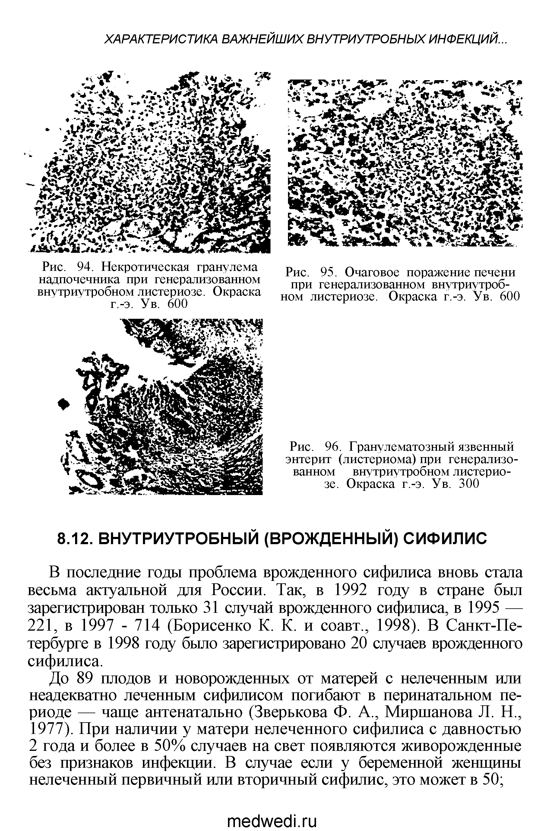 Рис. 96. Гранулематозный язвенный энтерит (листериома) при генерализованном внутриутробном листериозе. Окраска г.-э. Ув. 300...