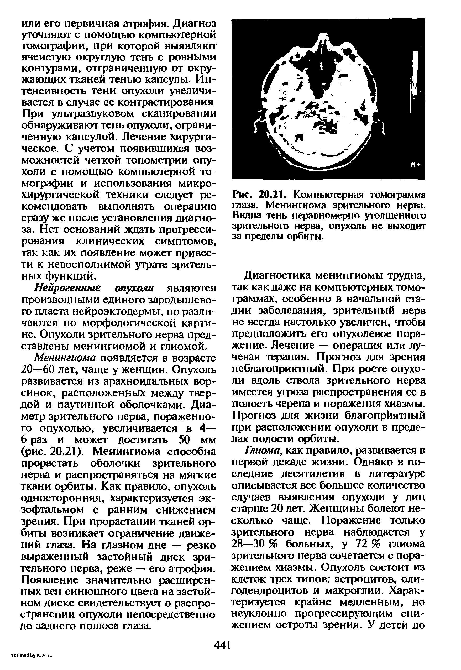 Рис. 20.21. Компьютерная томограмма глаза. Менингиома зрительного нерва. Видна тень неравномерно утолщенного зрительного нерва, опухоль не выходит за пределы орбиты.