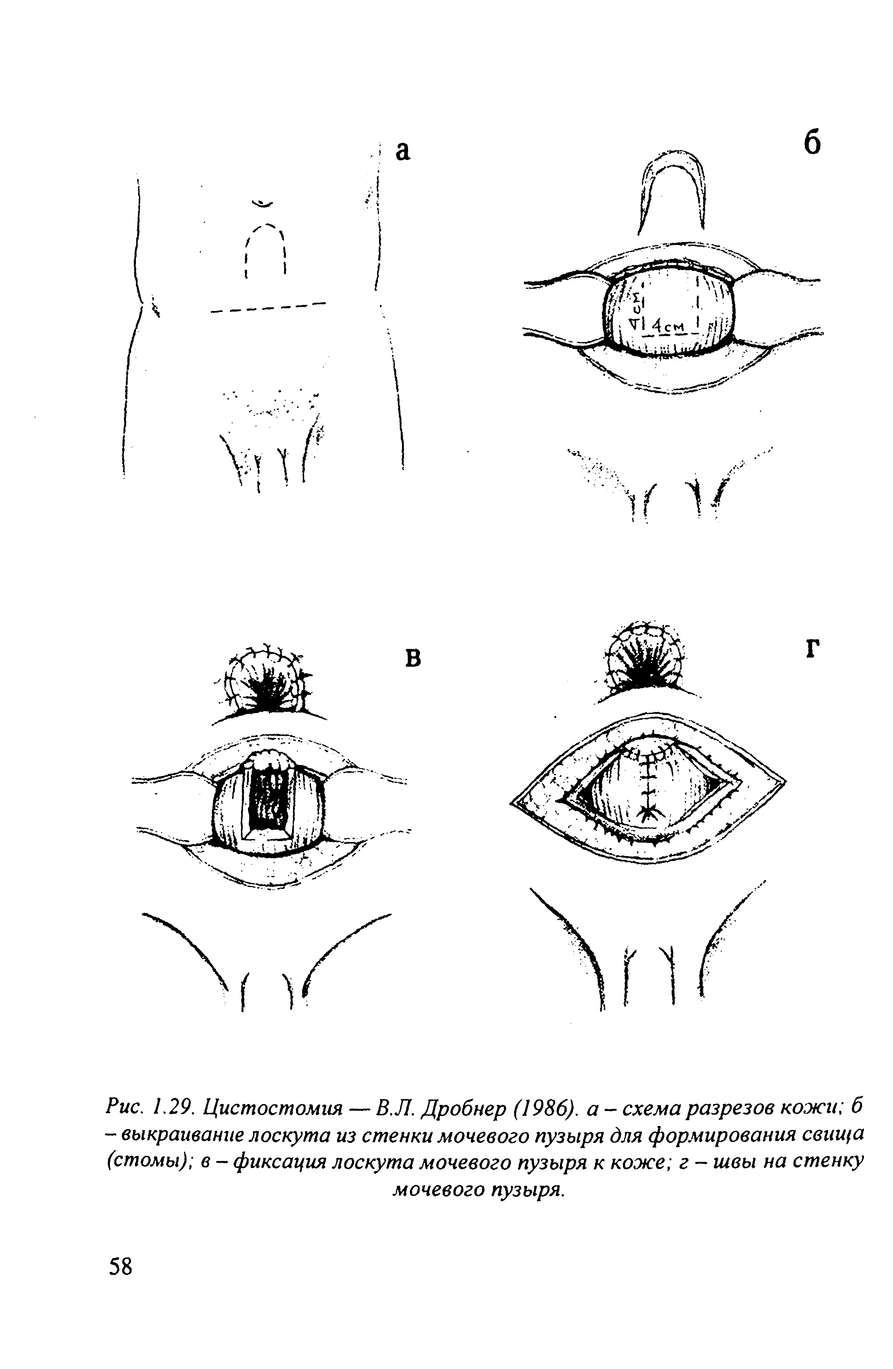 Рис. 1.29. Цистостомия — В.Л. Дробнер (1986). а - схема разрезов кожи б - выкраивание лоскута из стенки мочевого пузыря для формирования свища (стомы) в - фиксация лоскута мочевого пузыря к коже г - швы на стенку мочевого пузыря.