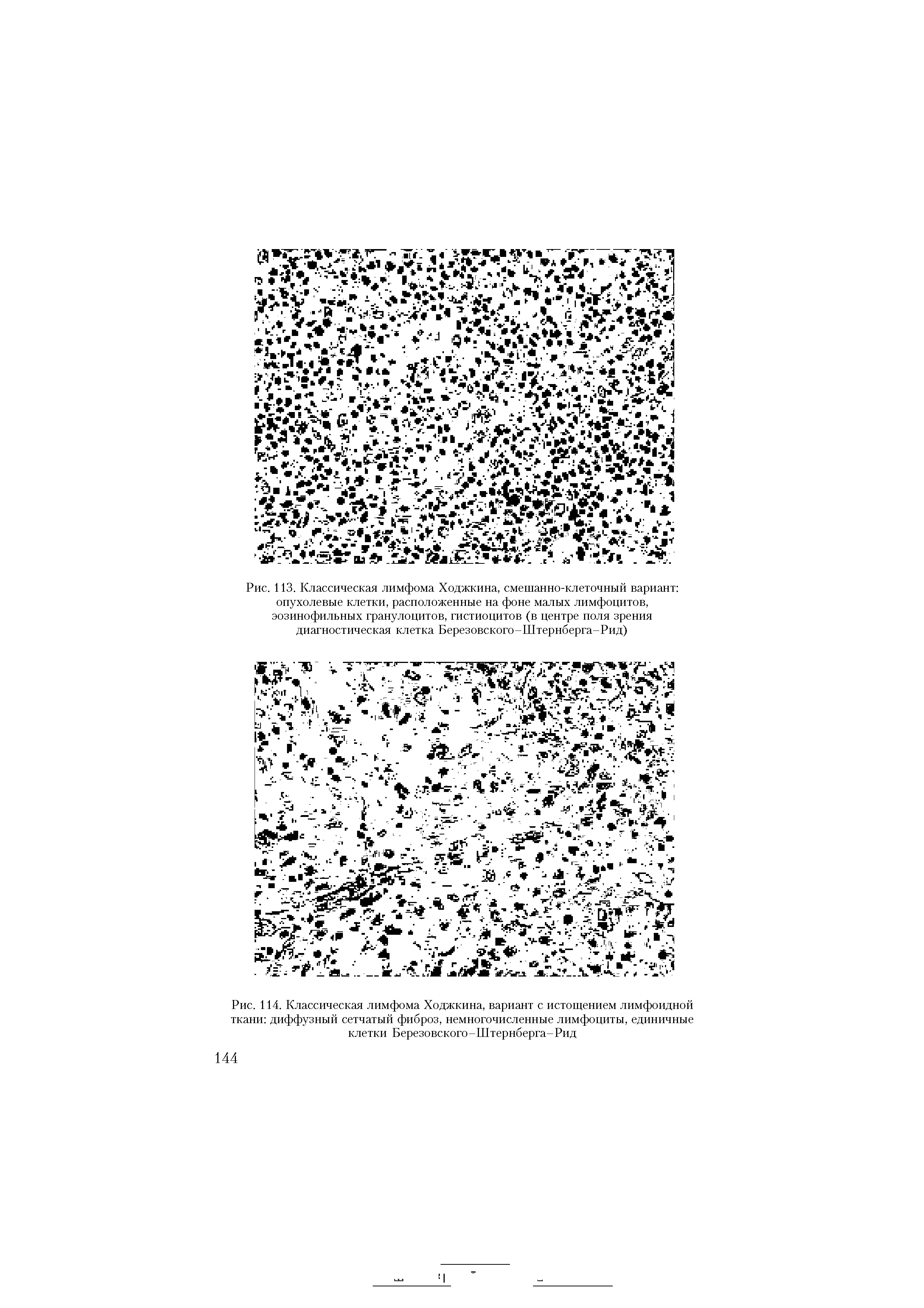 Рис. 114. Классическая лимфома Ходжкина, вариант с истощением лимфоидной ткани диффузный сетчатый фиброз, немногочисленные лимфоциты, единичные клетки Березовского-Штернберга-Рид...