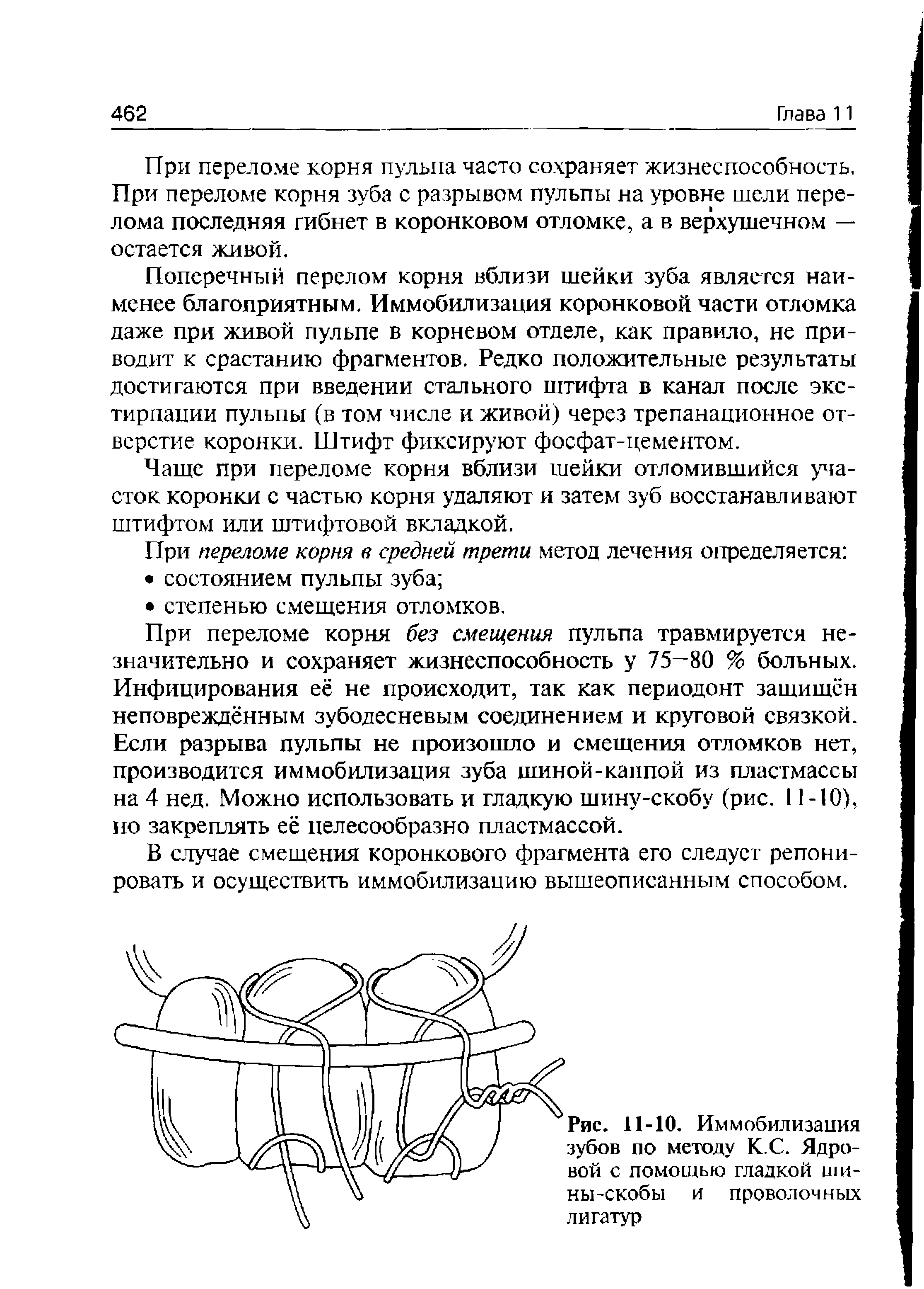 Рис. 11-10. Иммобилизация зубов по методу К.С. Ядровой с помощью гладкой шины-скобы и проволочных лигатур...