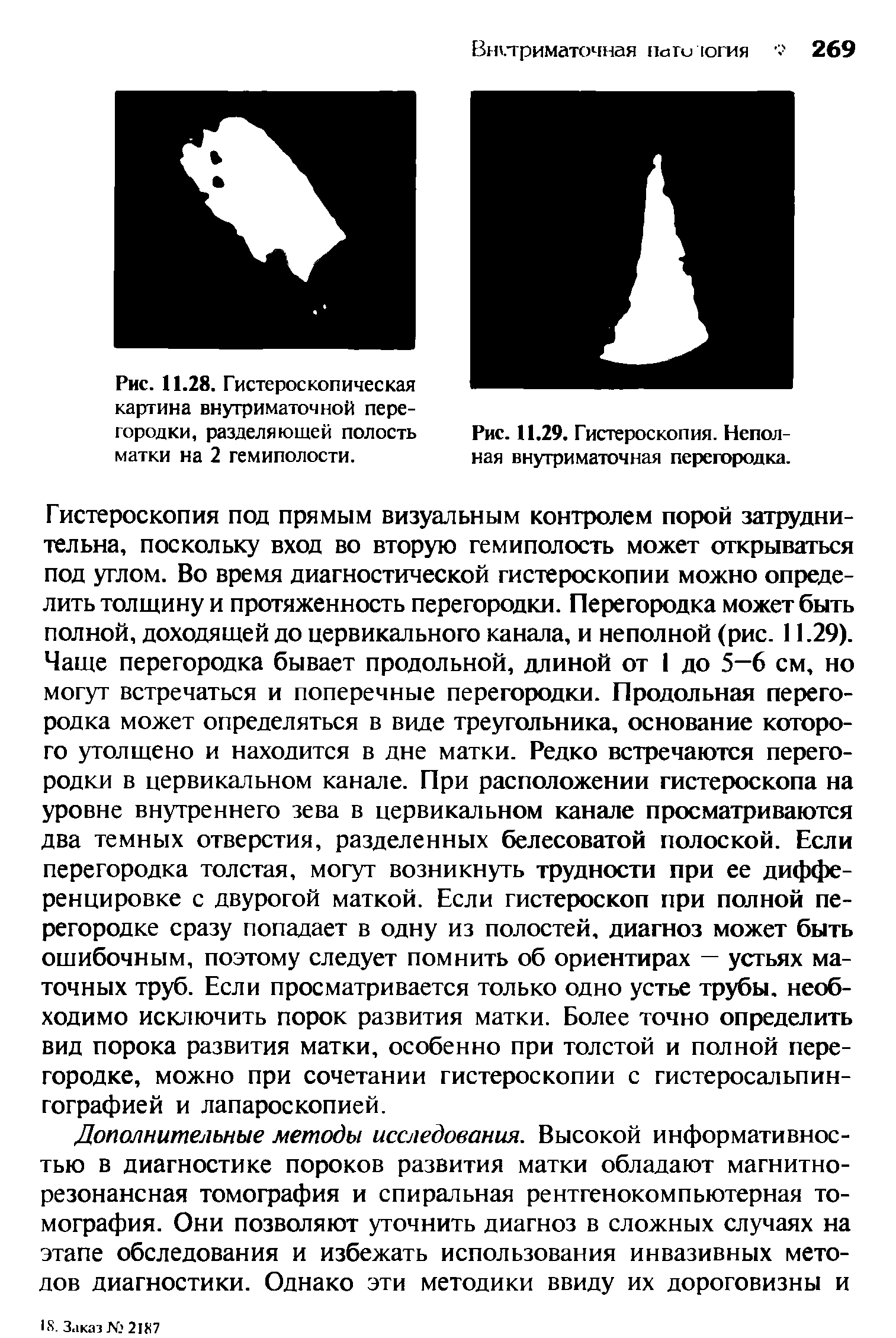 Рис. 11.28. Гистероскопическая картина внутриматочной перегородки, разделяющей полость матки на 2 гемиполости.