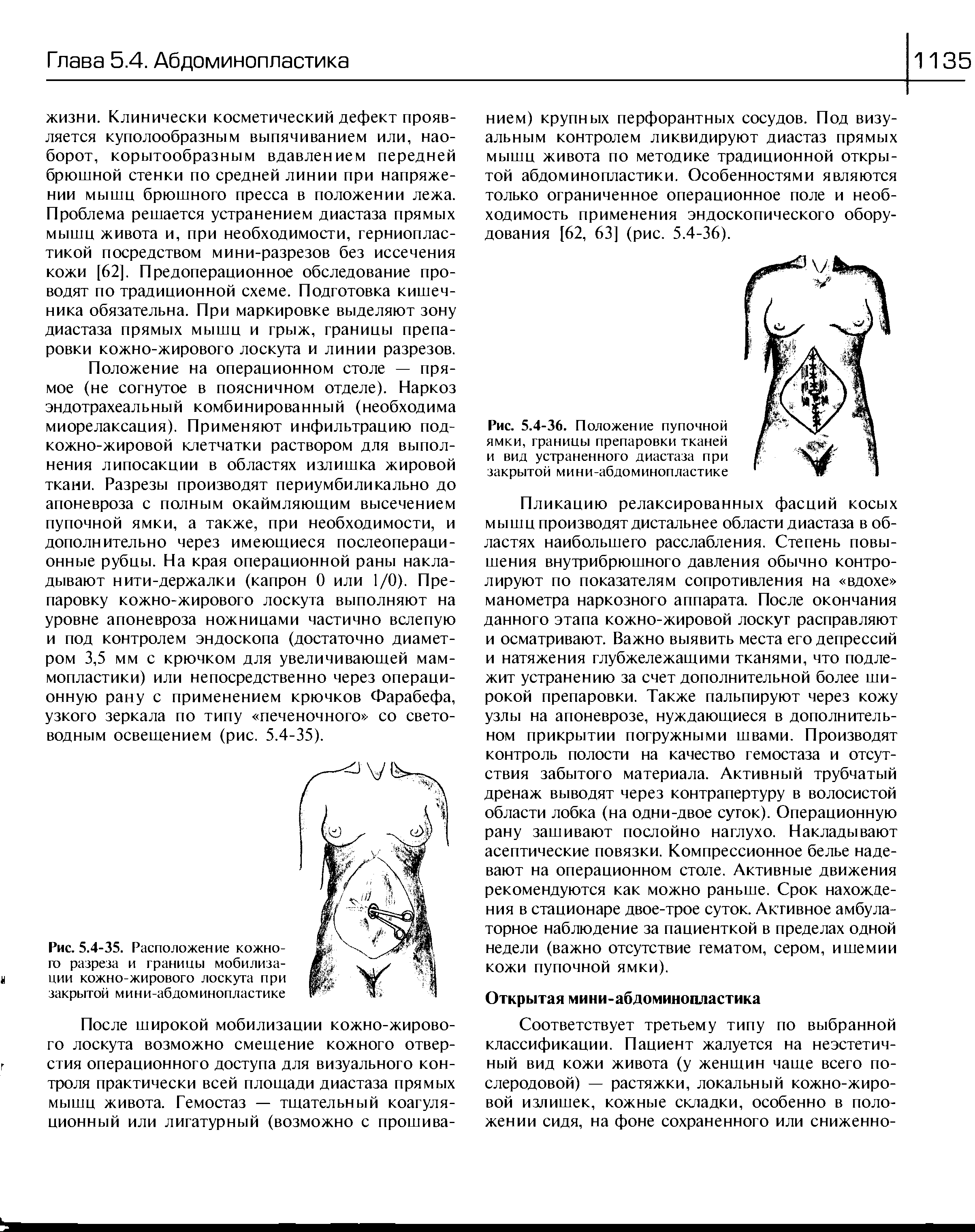 Рис. 5.4-35. Расположение кожного разреза и границы мобилиза-ц ции кожно-жирового лоскута при закрытой мини-абдоминопластике...