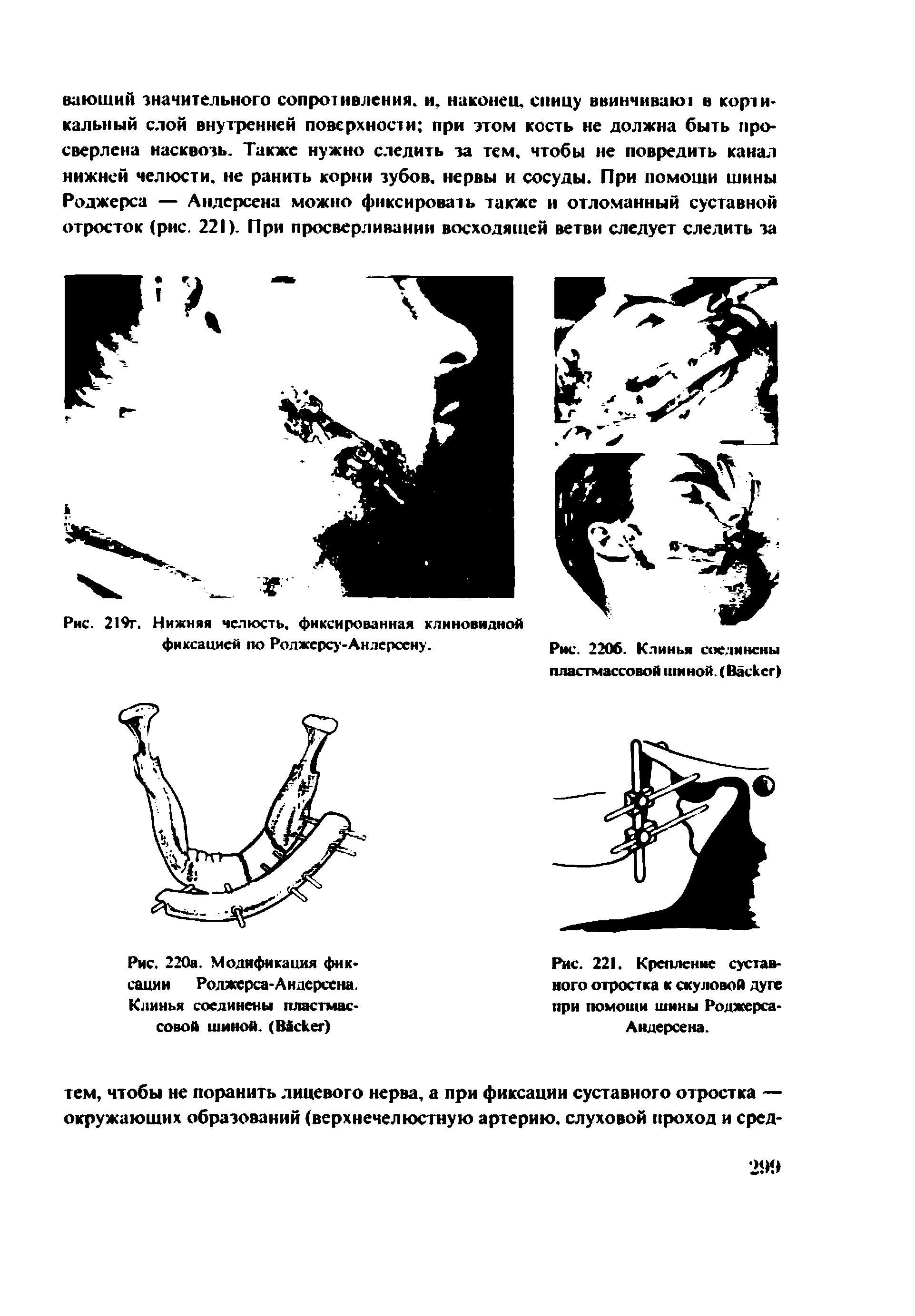 Рис. 220а. Модификация фиксации Роджерса-Андерсена. Клинья соединены пластмассовой шиной. (B )...