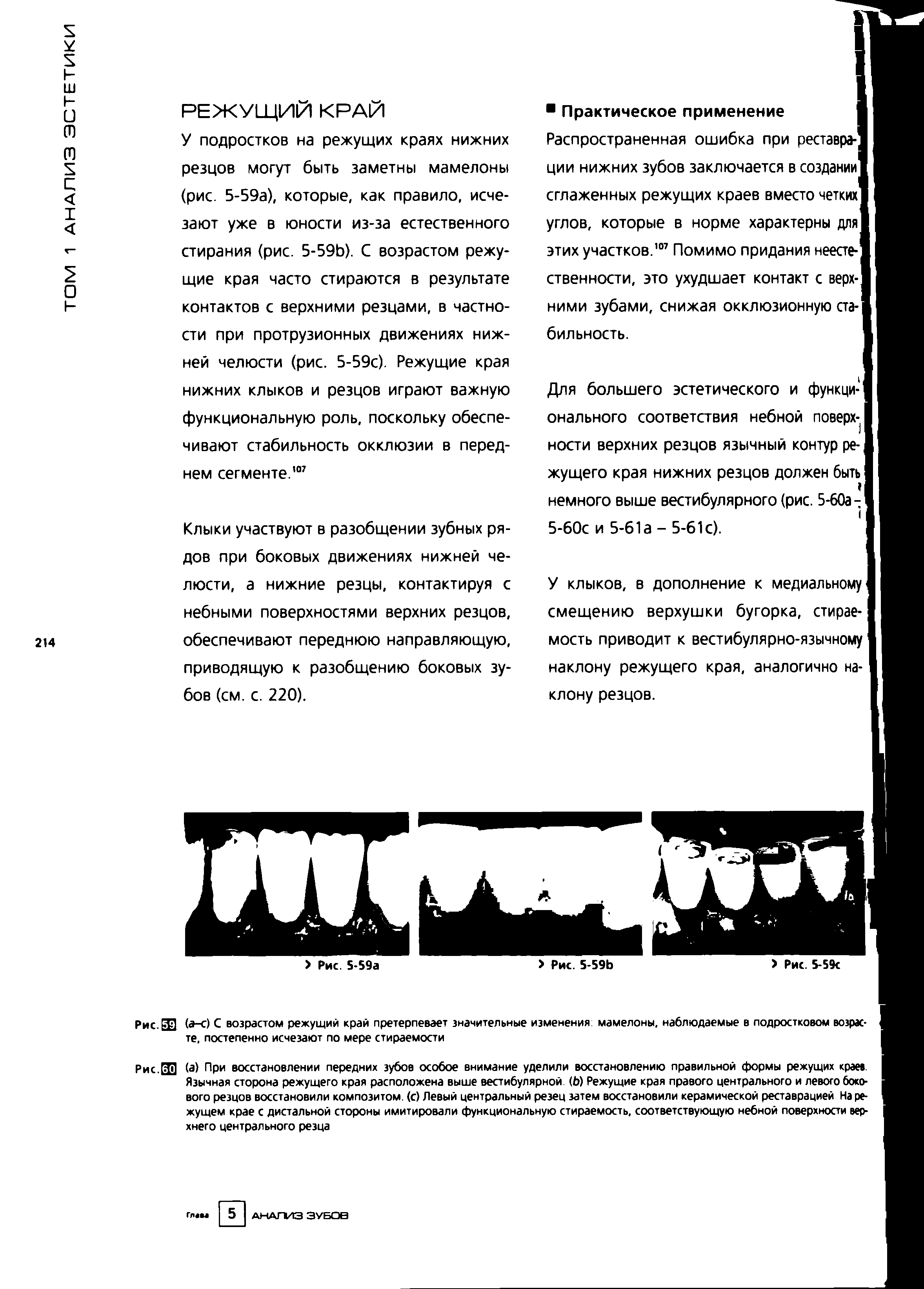 Рис.ЗЛ (а-с) С возрастом режущий край претерпевает значительные изменения мамелоны, наблюдаемые в подростковом возрас- 1 те, постепенно исчезают по мере стираемое I...