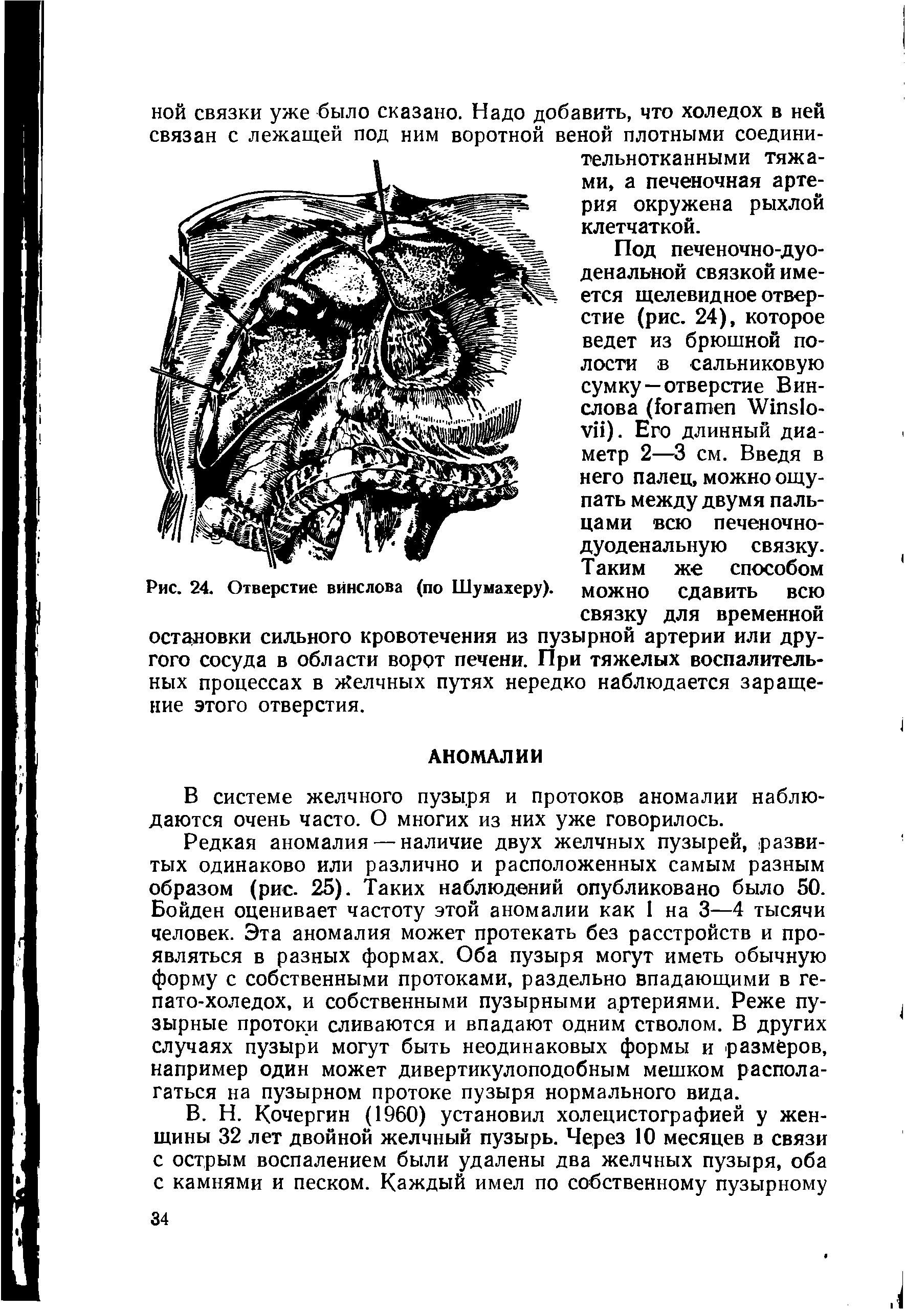 Рис. 24. Отверстие винслова (по Шумахеру). МОЖНО Сдавить ВСЮ связку для временной остановки сильного кровотечения из пузырной артерии или другого сосуда в области ворот печени. При тяжелых воспалительных процессах в Желчных путях нередко наблюдается заращение этого отверстия.